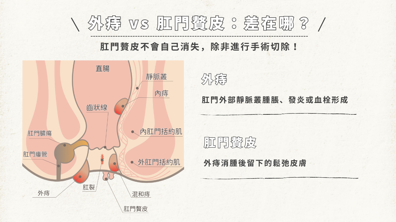 外痔 vs 肛門贅皮差異圖解:肛門結構與外痔、內痔、肛門贅皮位置說明