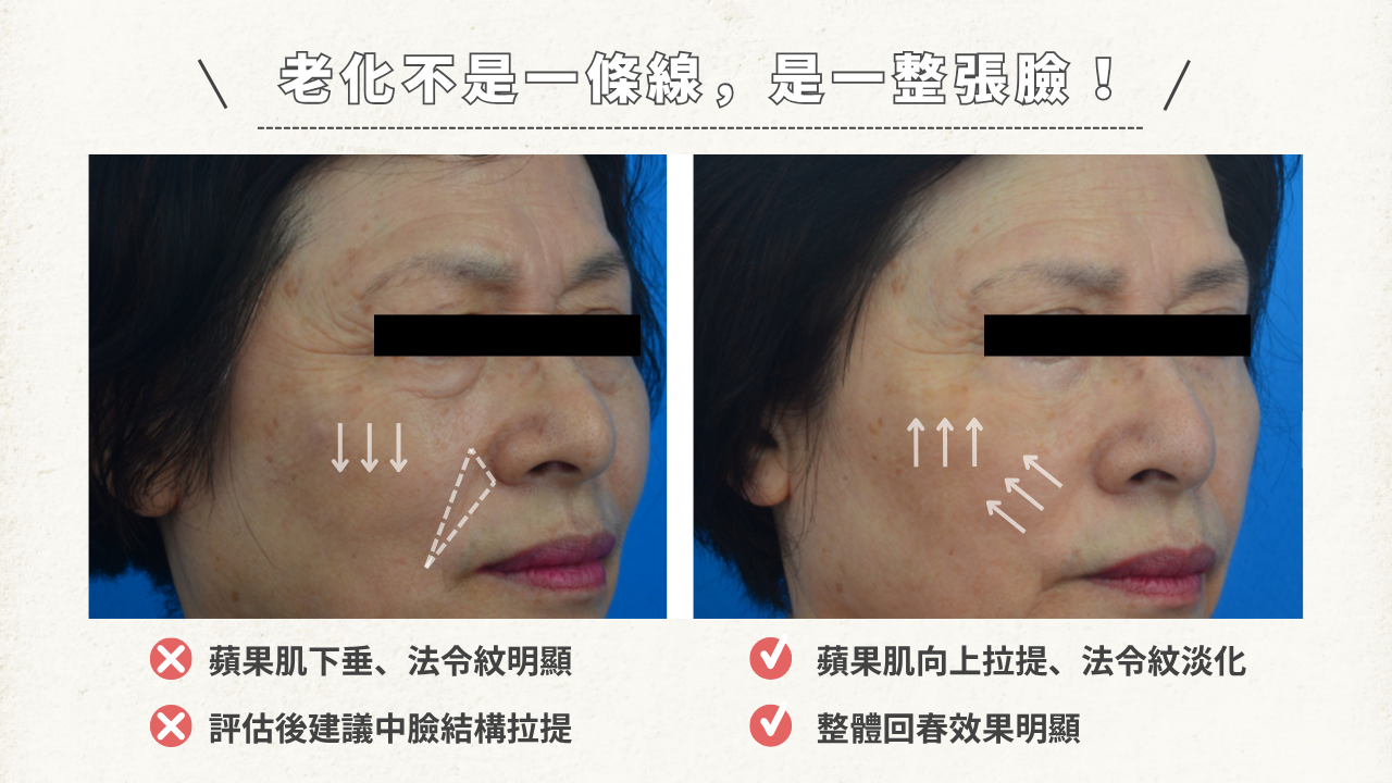 法令紋不是單一問題,而是整體臉部結構下垂的結果。 當中下臉出現鬆垮、脂肪堆積、肌肉無力時,不只法令紋變深,嘴邊肉與木偶紋也會隨之加劇。 想回到緊緻立體的輪廓?需要從「中下臉拉提」進行全方位改善!