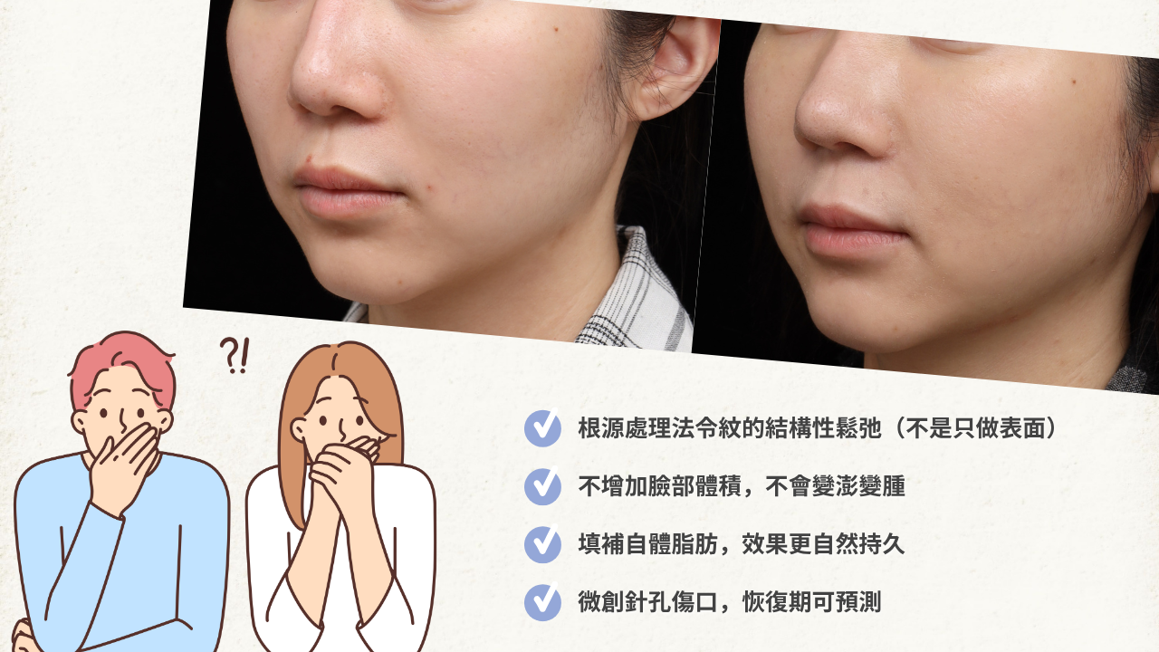 左右兩張女性側臉的對比圖,展示了針刀治療法令紋後臉部線條的改善。圖片下方列出針刀治療法令紋的優勢,包含根源處理結構性鬆弛、不增加臉部體積、填補自體脂肪效果更持久,以及微創針孔傷口恢復期可預測。