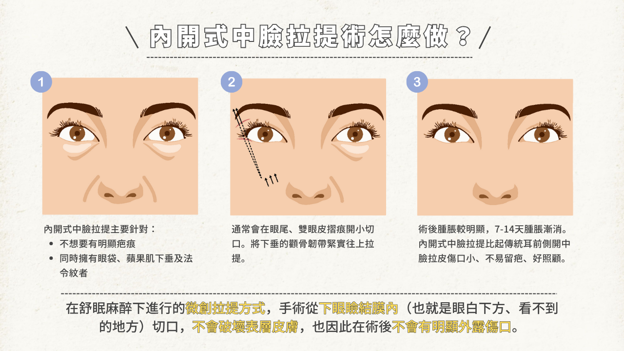 內開式中臉拉提手術圖解,從眼瞼內微創切口上提顴骨韌帶,改善眼袋與法令紋,術後腫脹7至14天消退。