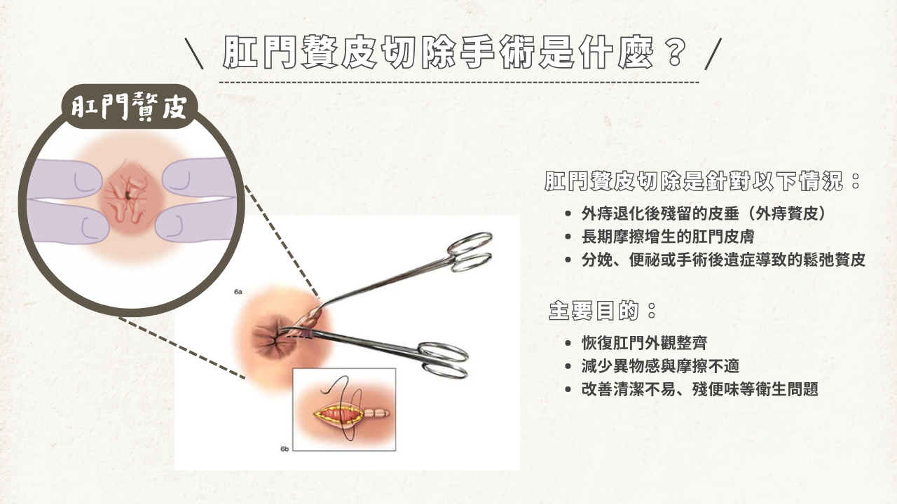 圖解說明肛門贅皮的形成原因與位置，以及進行【肛門贅皮切除】手術的主要目的，包含改善外觀與解決清潔困擾。