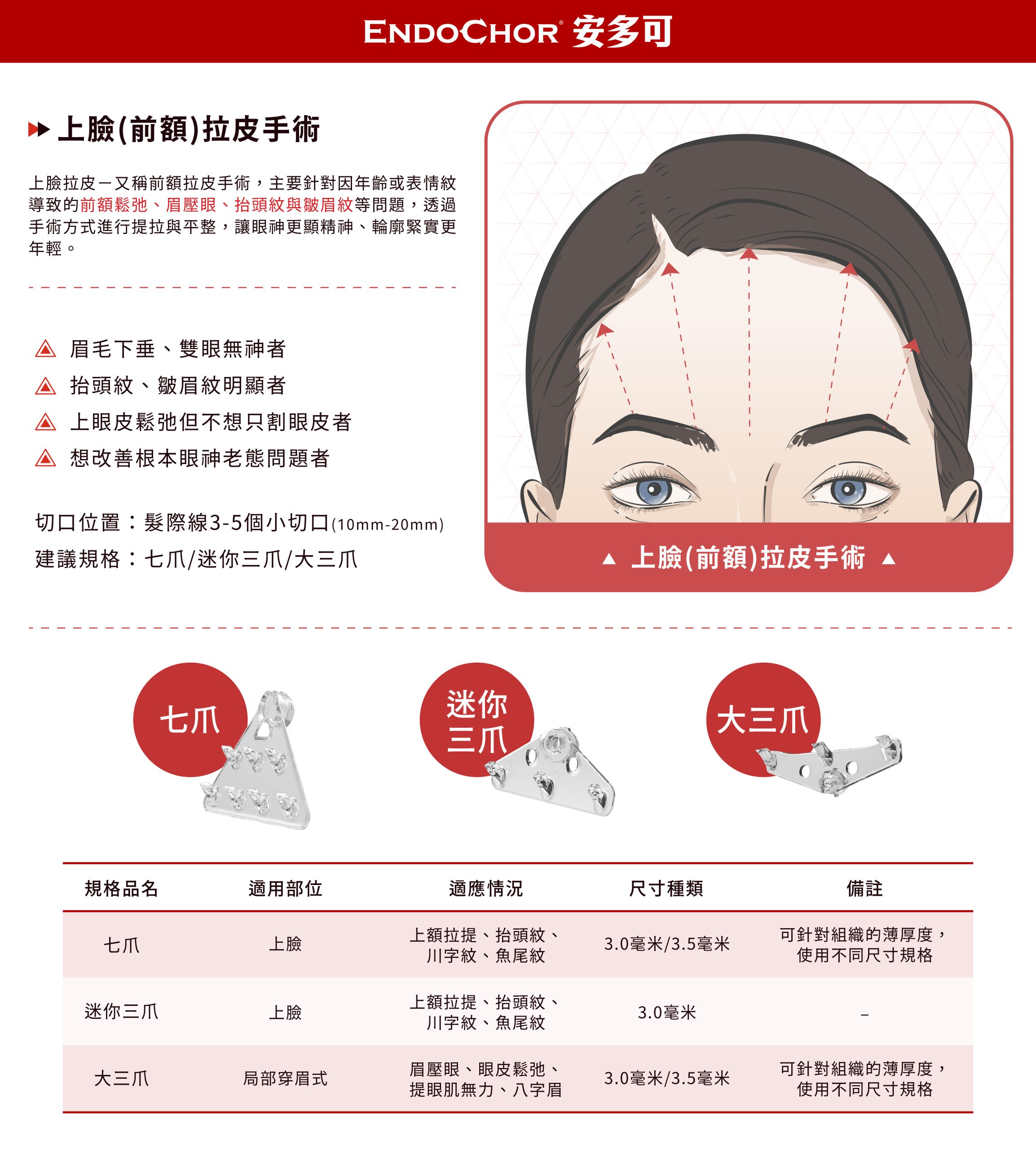 EndoChor安多可上臉(前額)拉皮手術示意圖,展示使用七爪、迷你三爪與大三爪改善眉壓眼與抬頭紋,並提供規格尺寸說明。