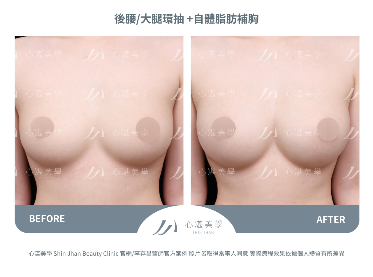 自體脂肪隆乳，術後一年脂肪穩定存活，胸型自然。罩杯增大1-1.5 CUP