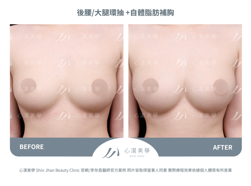 自體脂肪隆乳,術後一年脂肪穩定存活,胸型自然。罩杯增大1-1.5 CUP