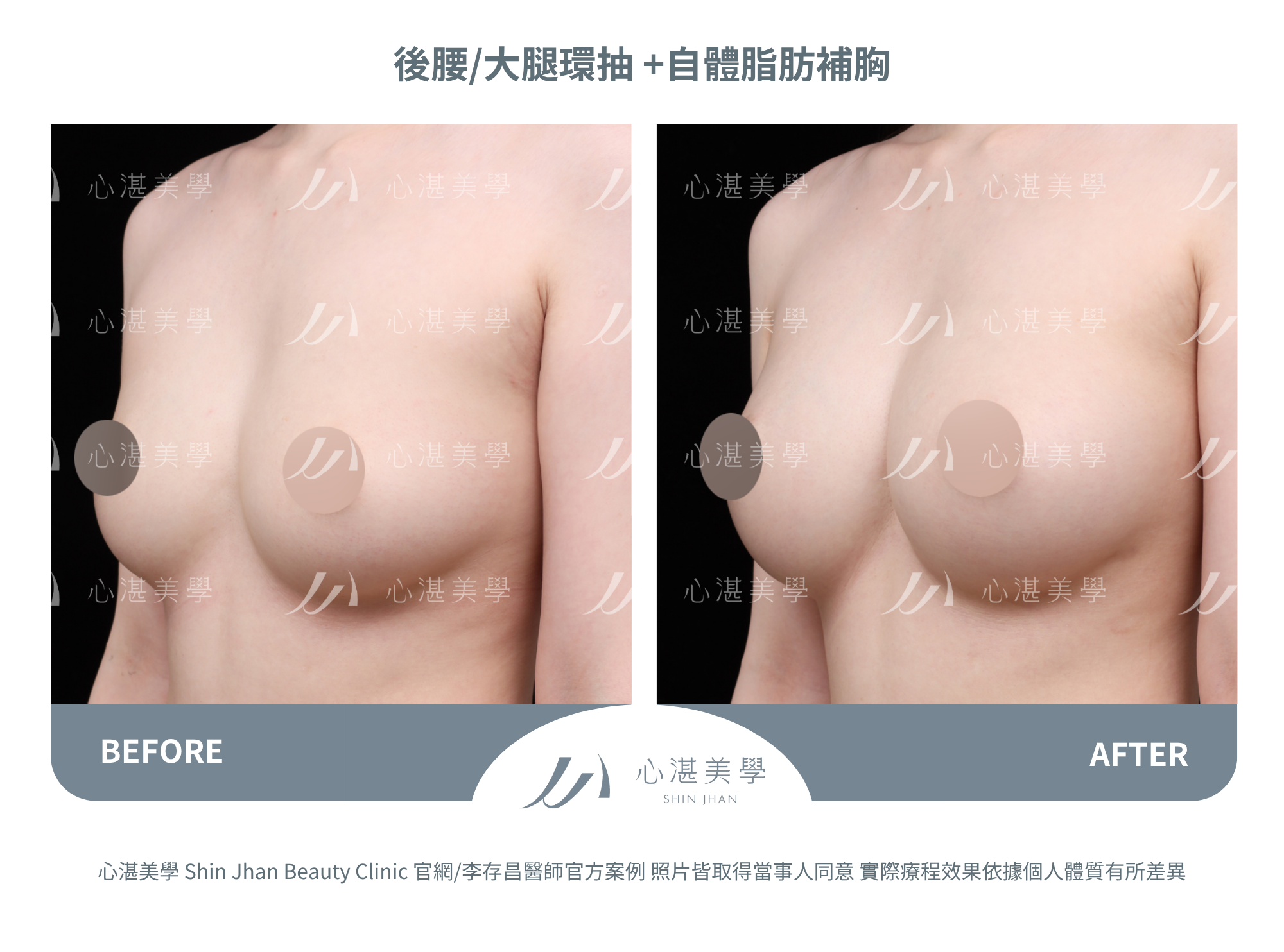 自體脂肪隆乳,術後一年脂肪穩定存活,胸型自然。罩杯增大1-1.5 CUP