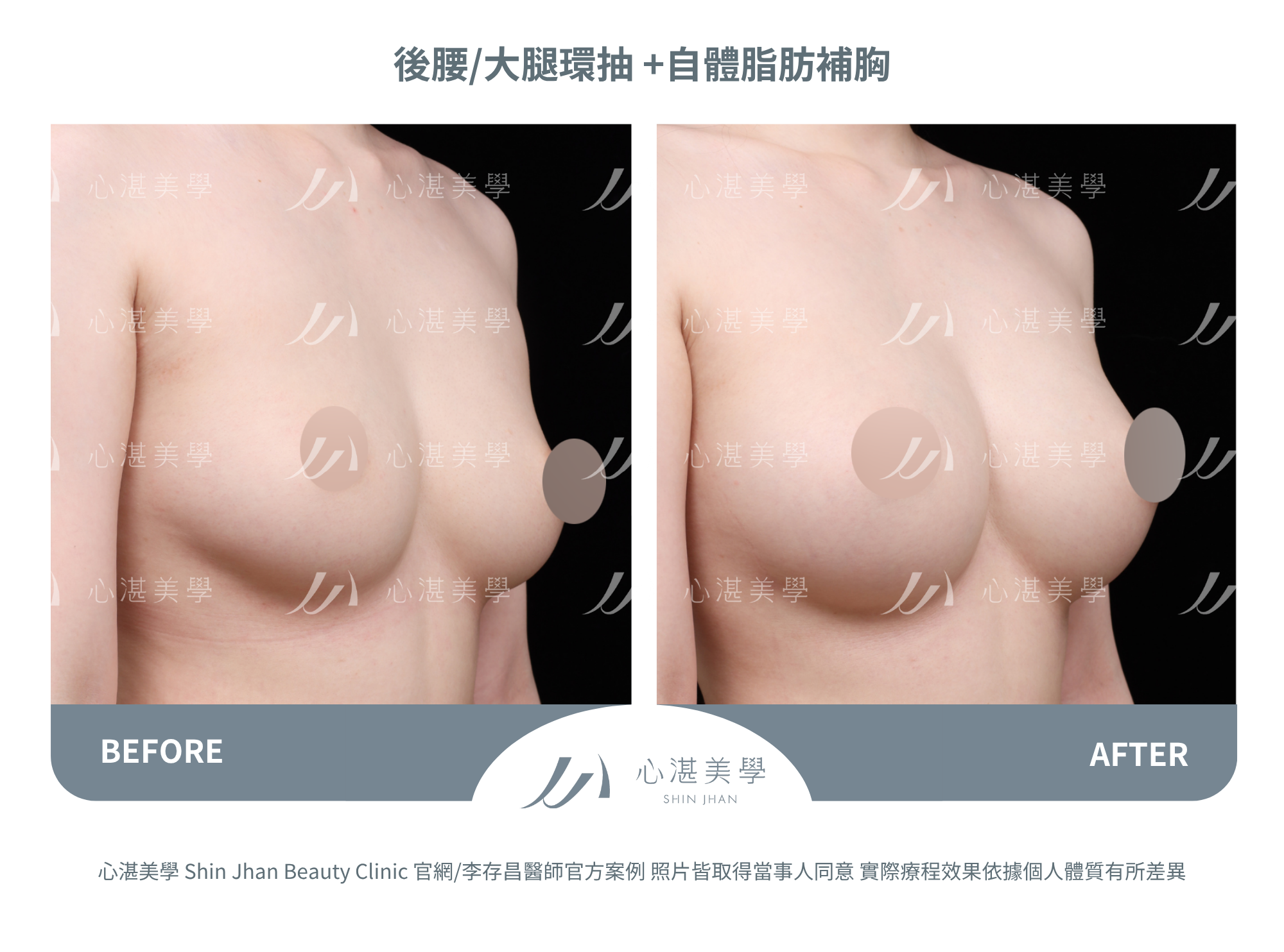 自體脂肪隆乳,術後一年脂肪穩定存活,胸型自然。罩杯增大1-1.5 CUP