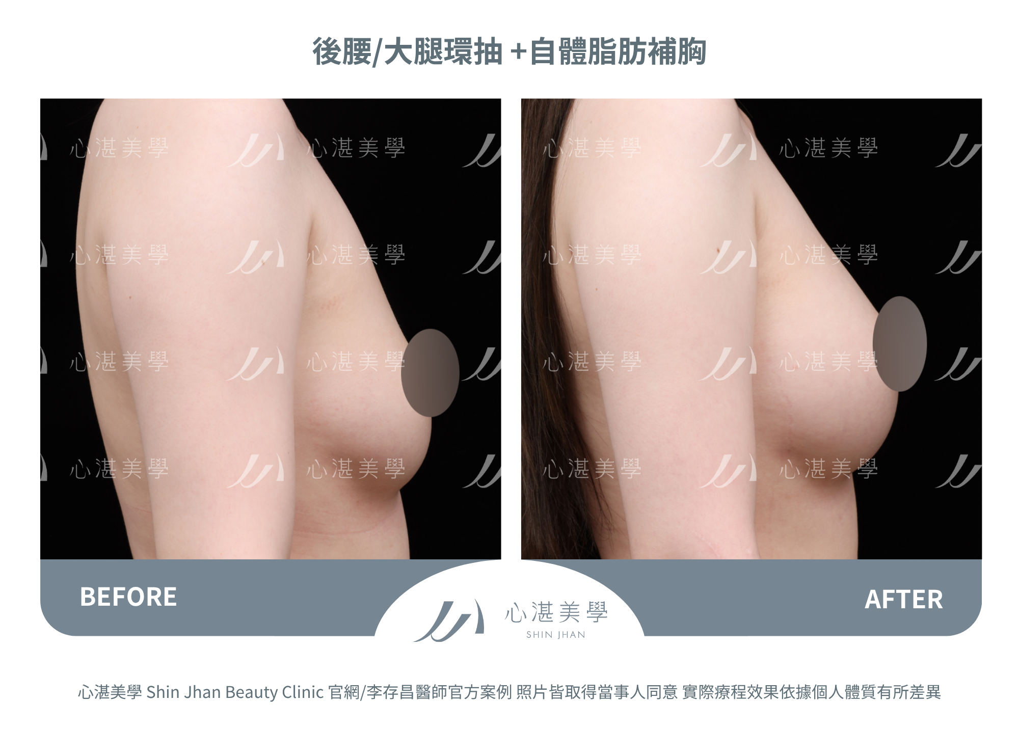 自體脂肪隆乳,術後一年脂肪穩定存活,胸型自然。罩杯增大1-1.5 CUP
