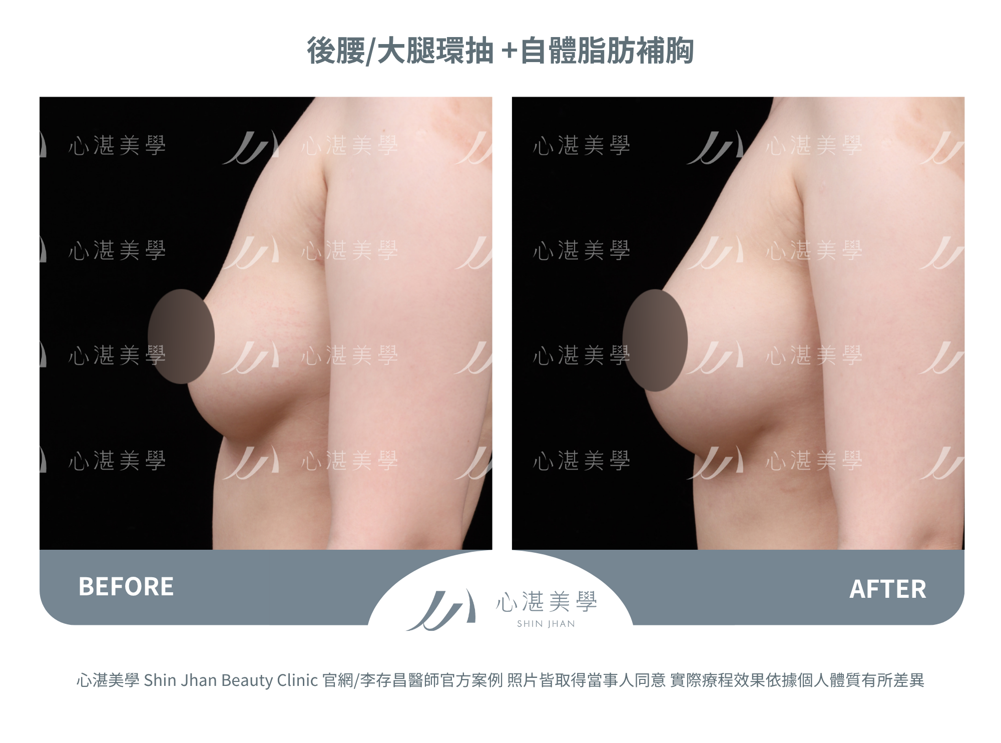 自體脂肪隆乳,術後一年脂肪穩定存活,胸型自然。罩杯增大1-1.5 CUP