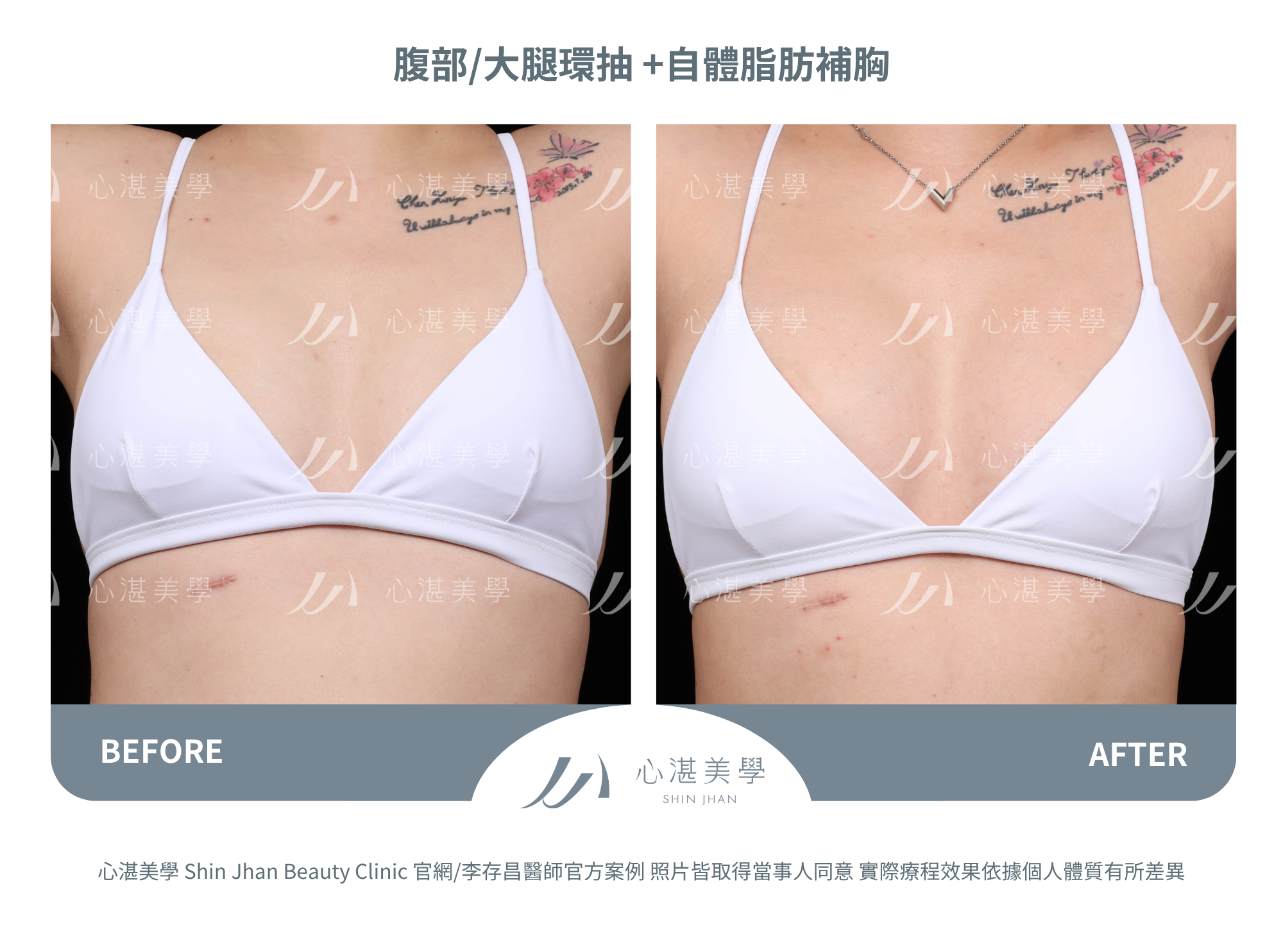 自體脂肪隆乳,吸收率較高+胸型自然。罩杯增大0.5-1 CUP