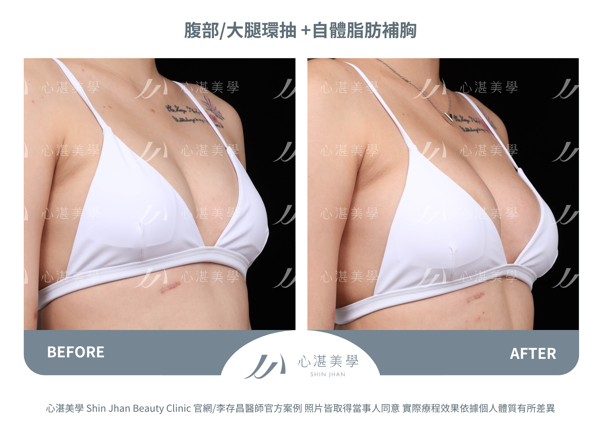 自體脂肪隆乳,吸收率較高+胸型自然。罩杯增大0.5-1 CUP