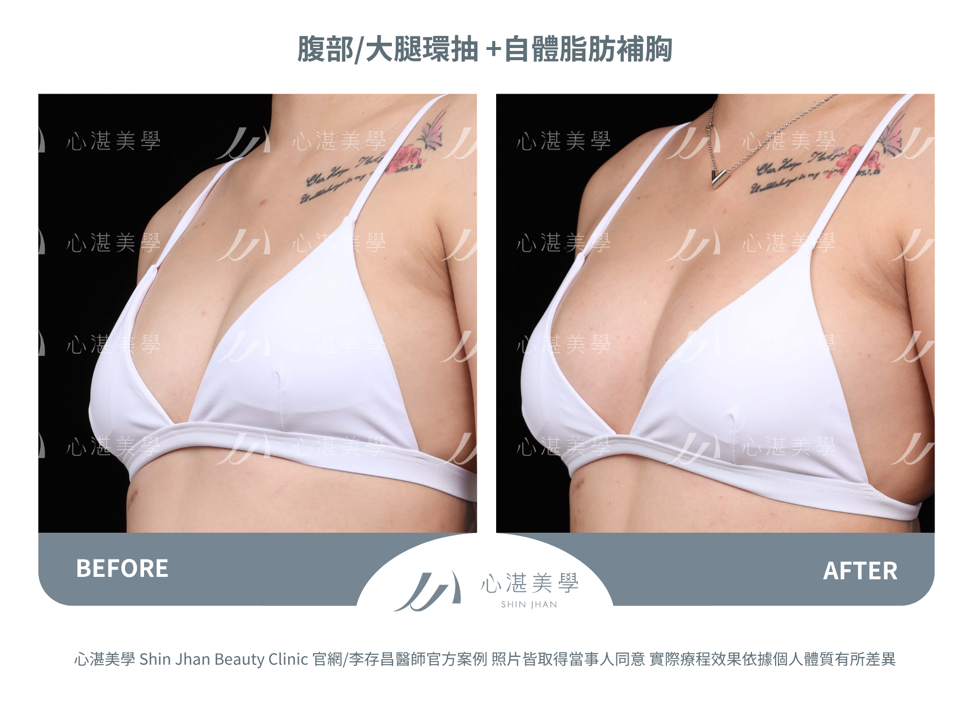 自體脂肪隆乳,吸收率較高+胸型自然。罩杯增大0.5-1 CUP