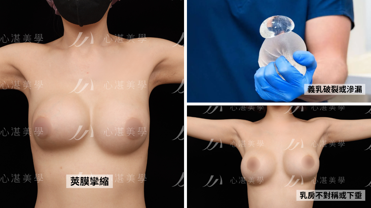 常見隆乳後遺症包括：
1.莢膜攣縮：乳房變硬、疼痛、形狀異常

2.義乳破裂或滲漏：可能發生在老化或外力撞擊後

3.乳房不對稱或下垂：可能因手術方式、恢復過程影響

這些問題多數與術後保養不當或未定期追蹤有關，因此術後定期檢查不可忽略。