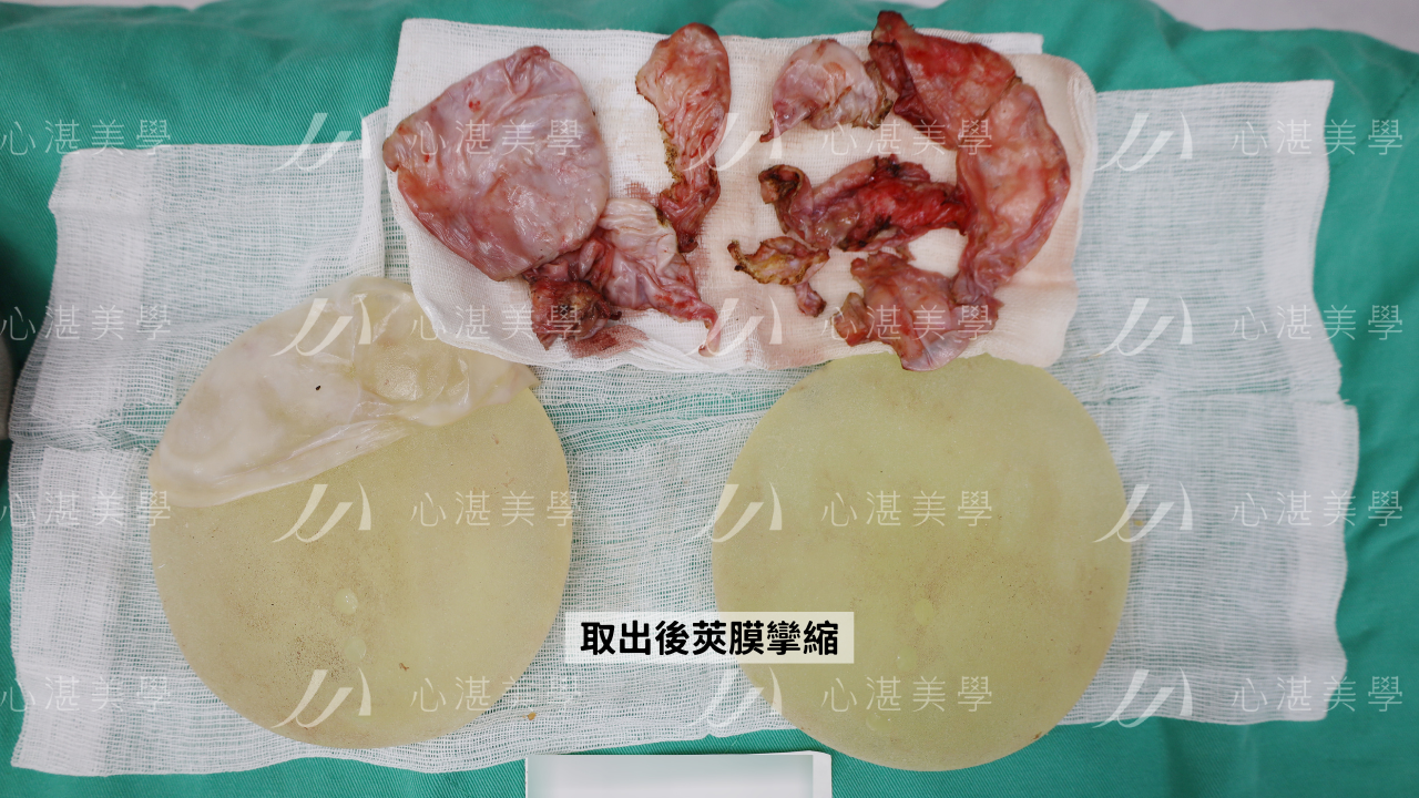 胸部莢膜攣縮的原因包含感染（特別是細菌生物膜的形成）、血腫/血清腫積聚、個人體質（疤痕增生、自體免疫疾病）、植入物尺寸過大或剝離空間不足、外力撞擊、以及術後照護不佳（如抽菸）等因素。 這些因素都可能刺激身體產生過度發炎反應，導致假體周圍的莢膜組織變厚、變硬並收縮，進而使胸部變形、變硬，甚至引發疼痛。 