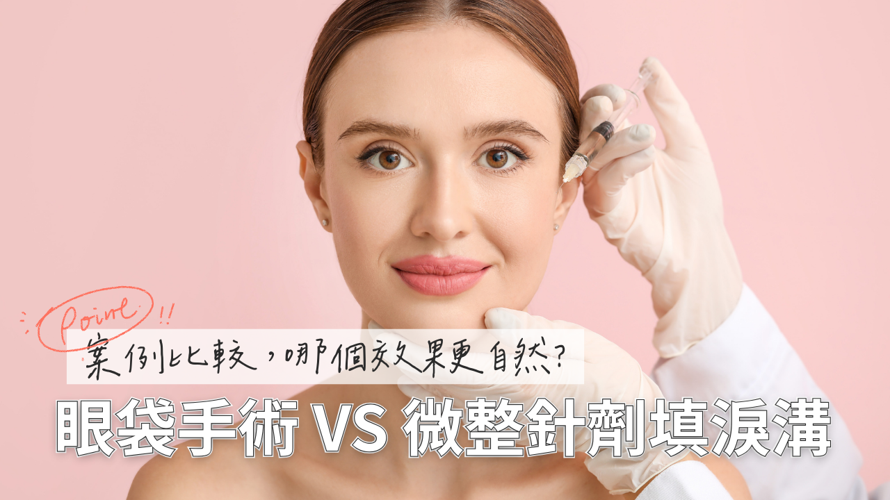 眼袋手術或微整填淚溝(例如:玻尿酸/膠原蛋白針)哪個更適合你?專業醫師詳細比較兩種療程效果、維持時間、恢復期,幫助你做出最安心的選擇。立即了解!