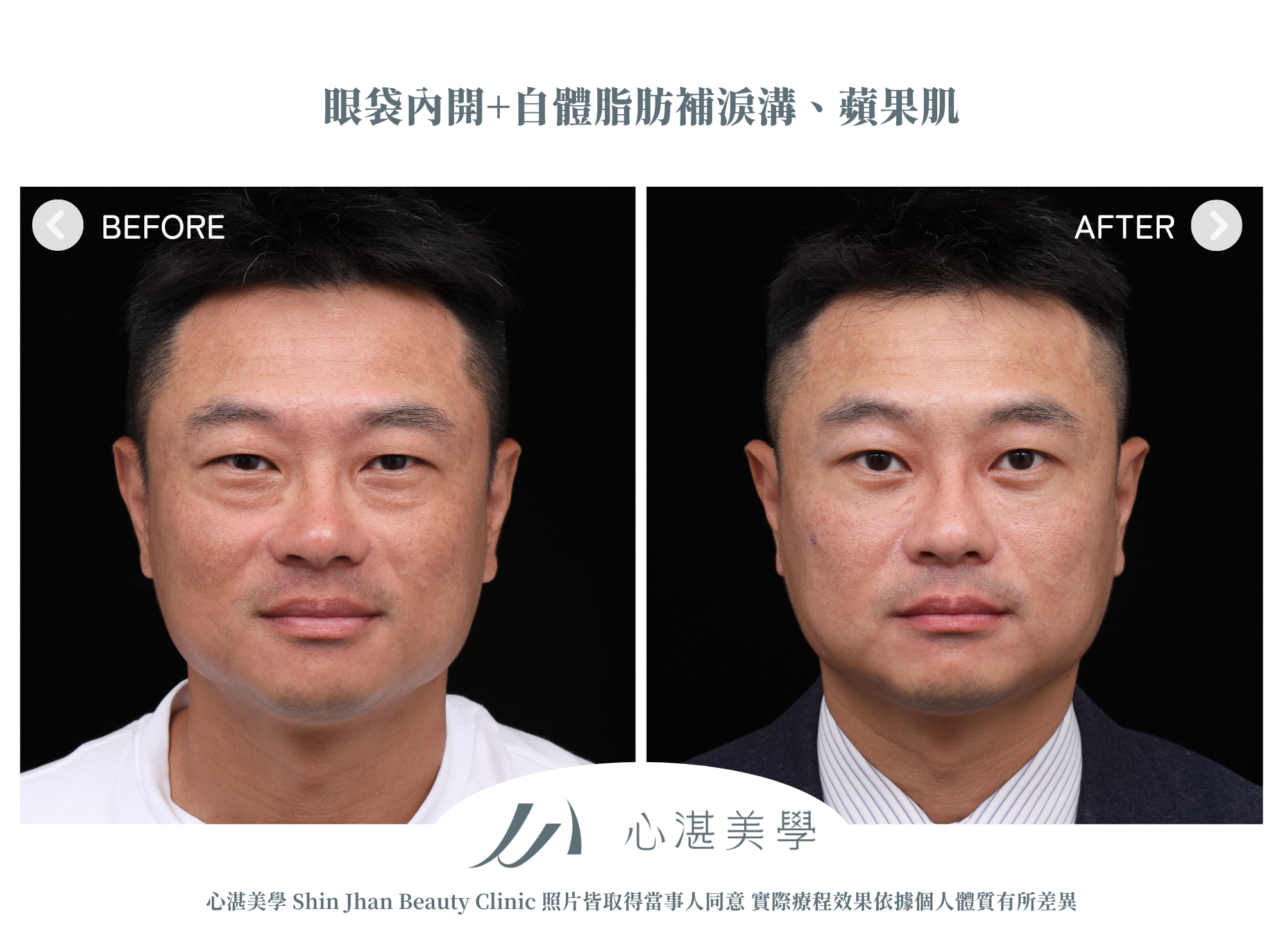 眼袋手術案例術前術後對比
