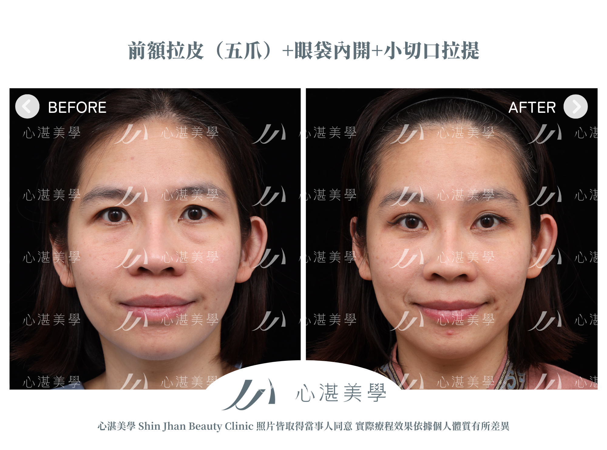 眼袋手術+內視鏡前額拉皮案例術前術後對比