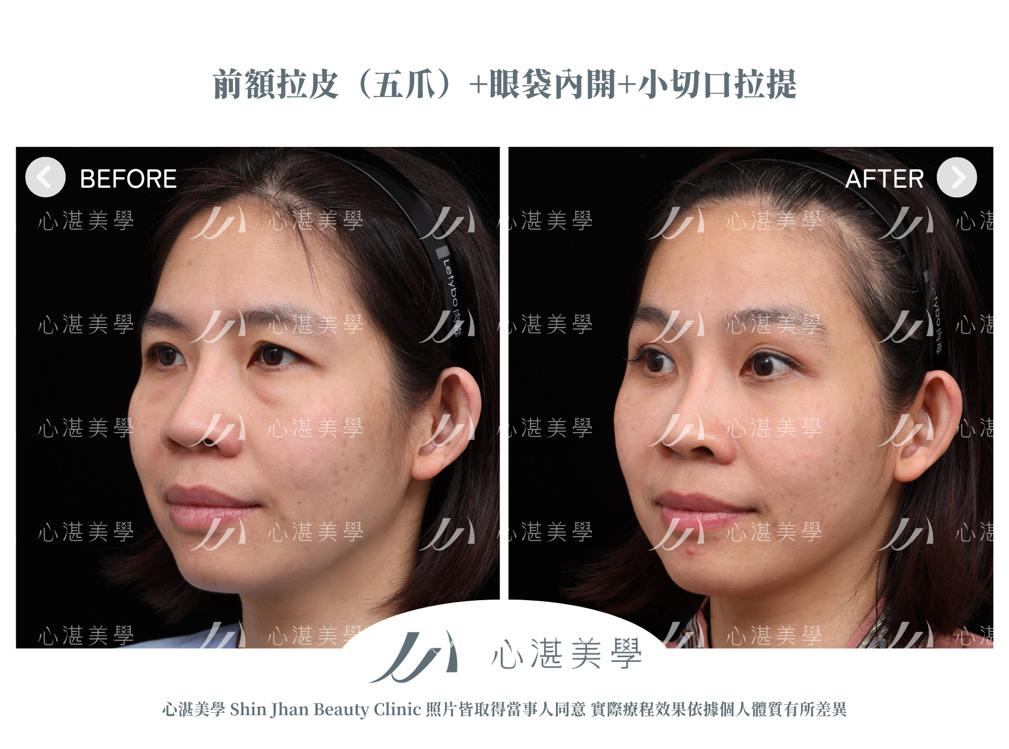 眼袋手術+內視鏡前額拉皮案例術前術後對比