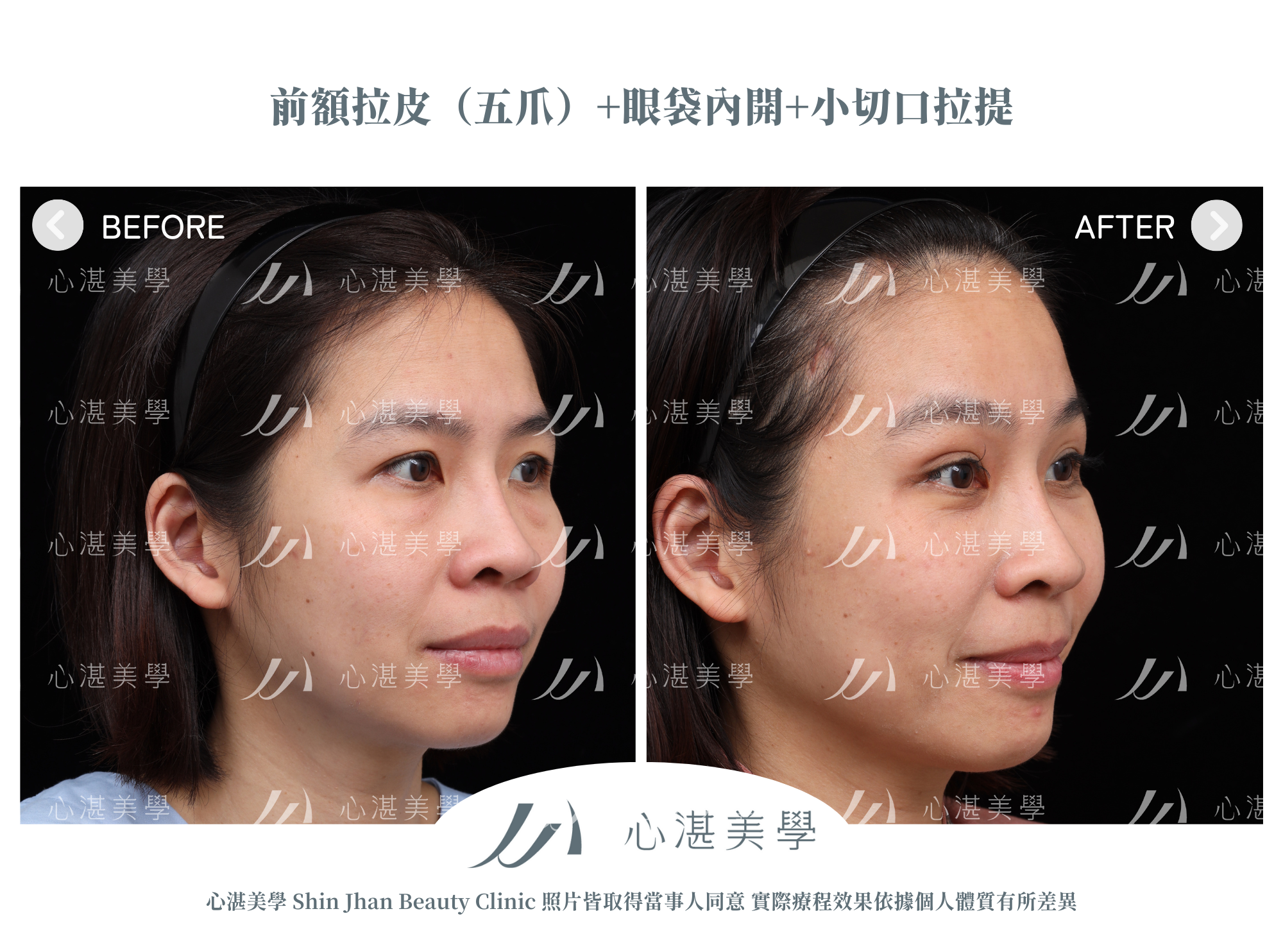 眼袋手術+內視鏡前額拉皮案例術前術後對比
