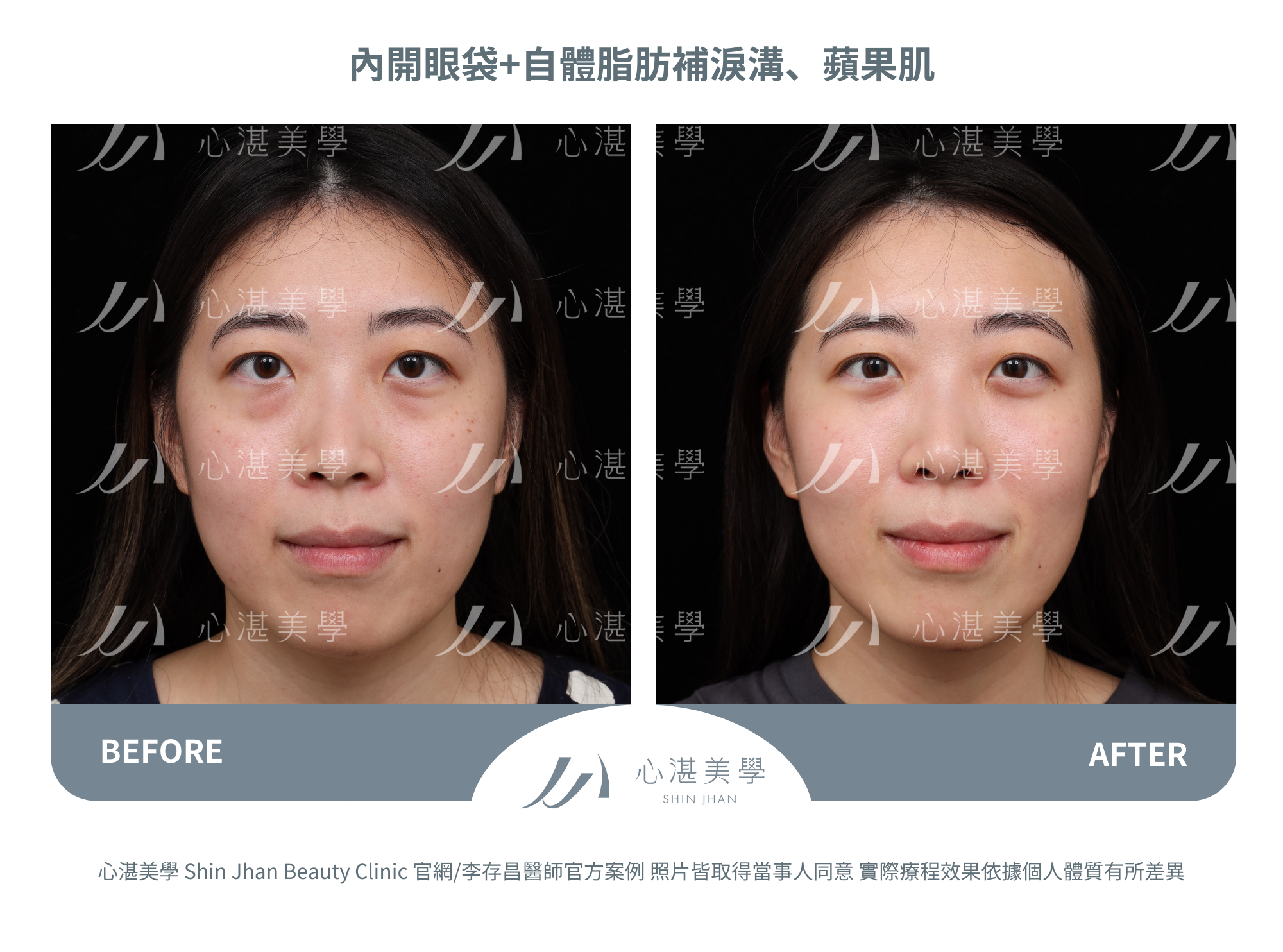 眼袋手術案例術前術後對比