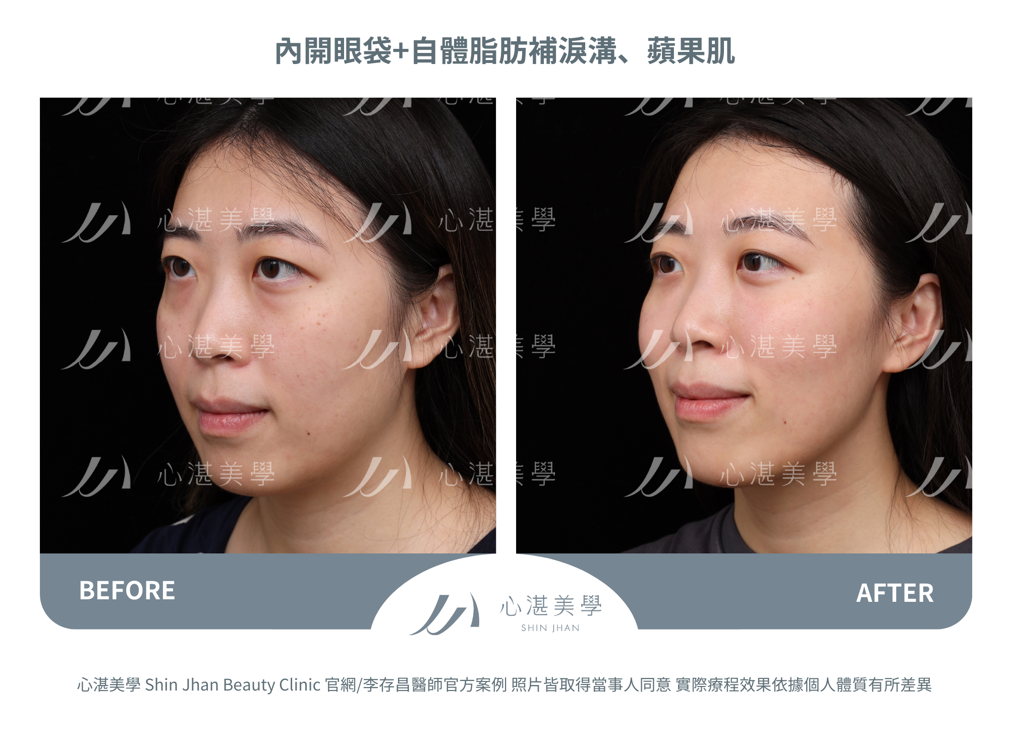 眼袋手術案例術前術後對比