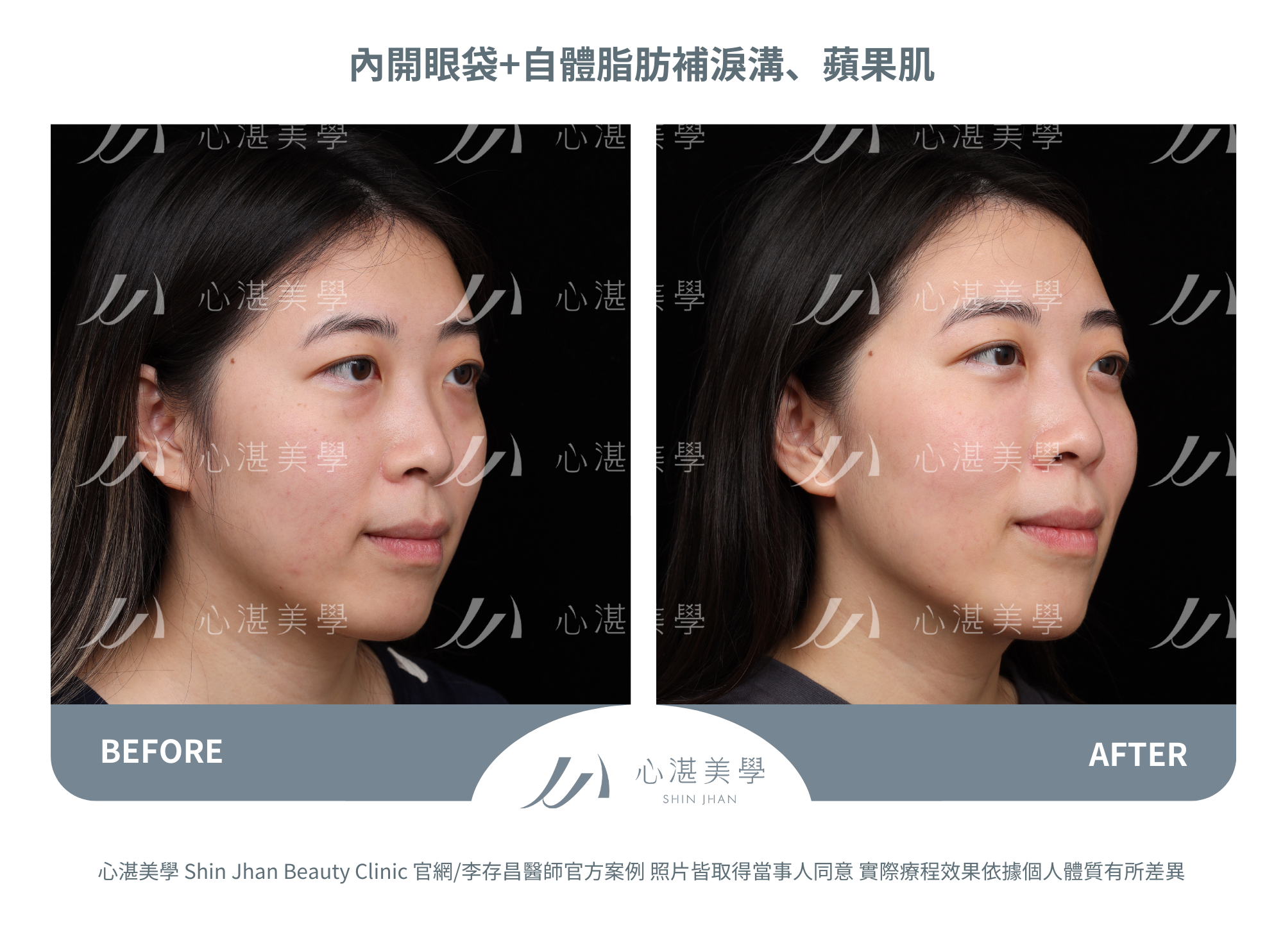 眼袋手術案例術前術後對比