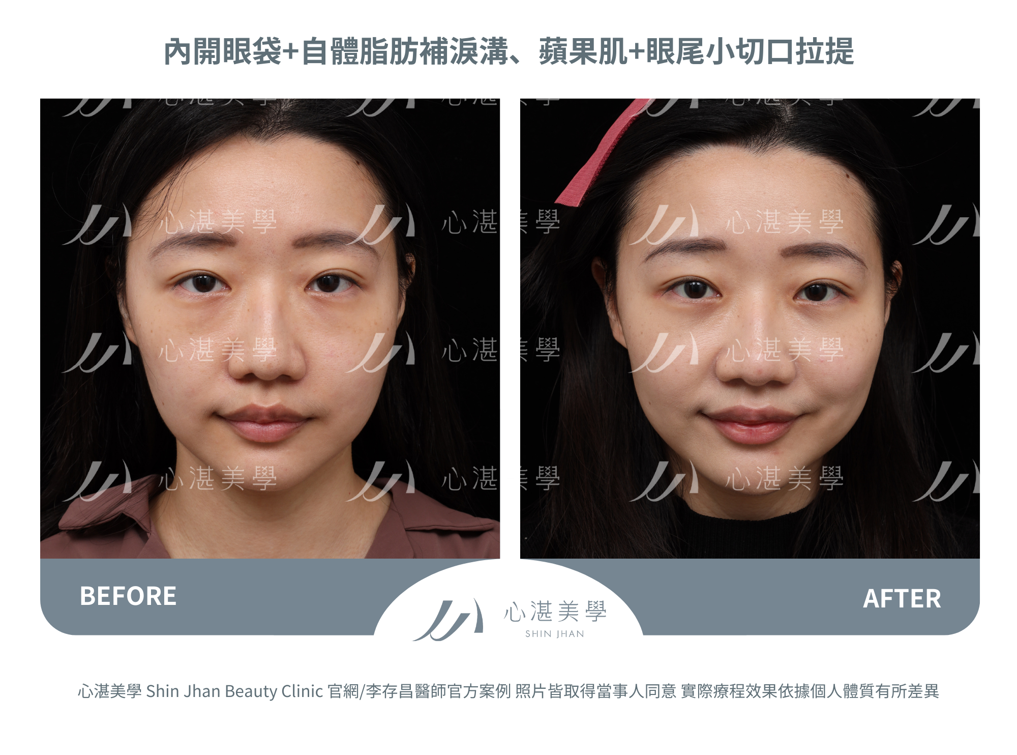 眼袋手術案例術前術後對比
