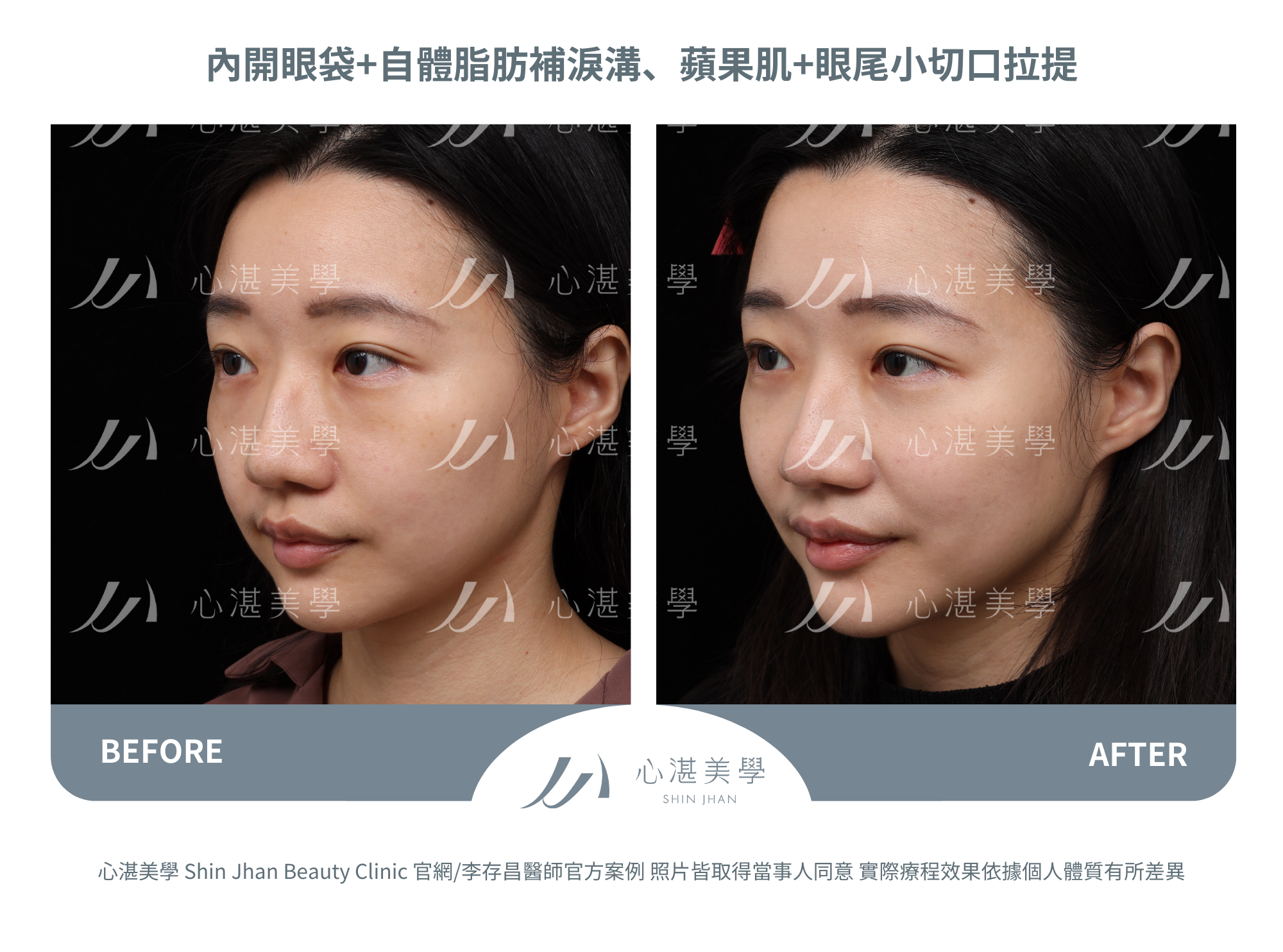 眼袋手術案例術前術後對比
