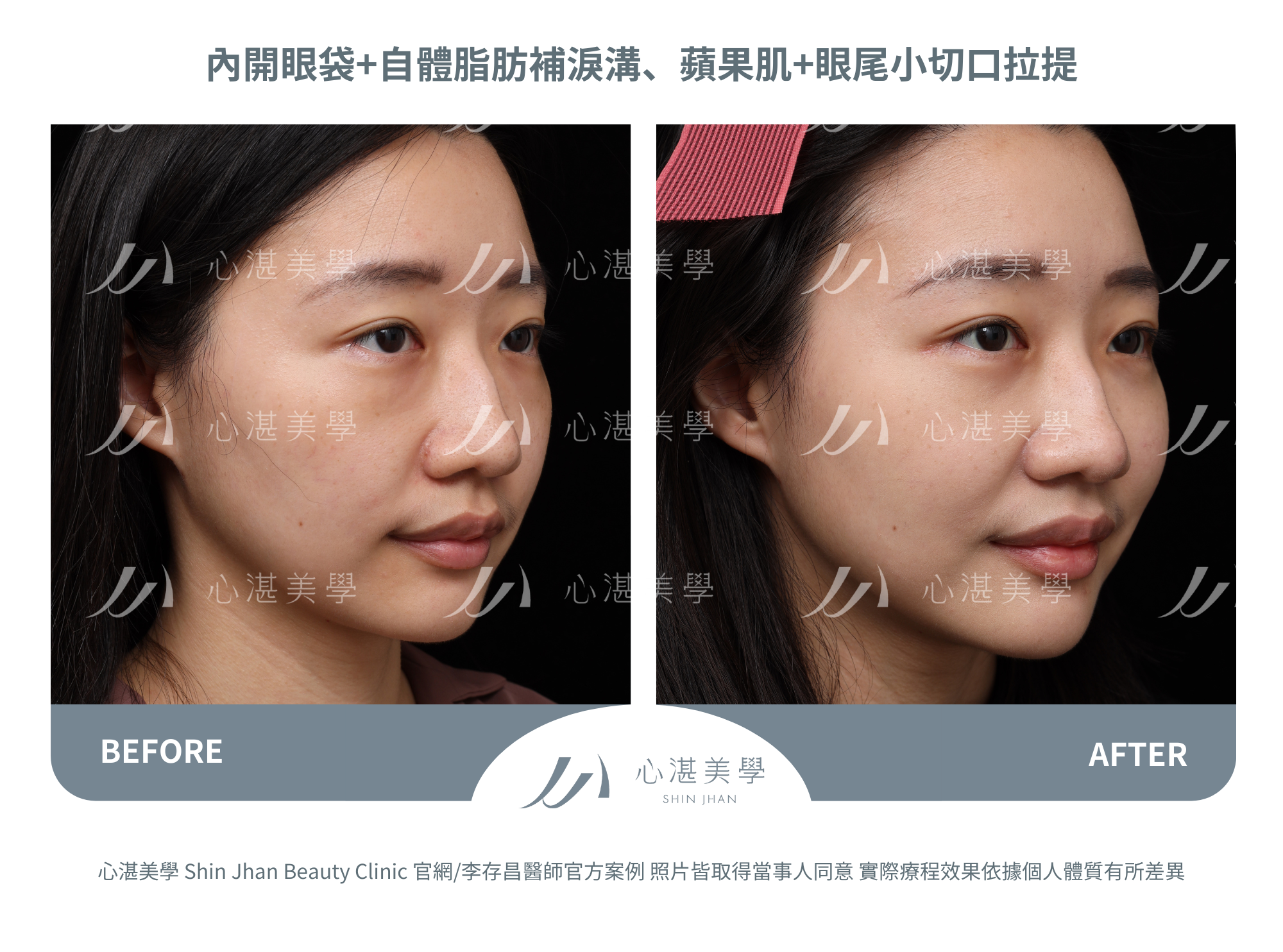 眼袋手術案例術前術後對比