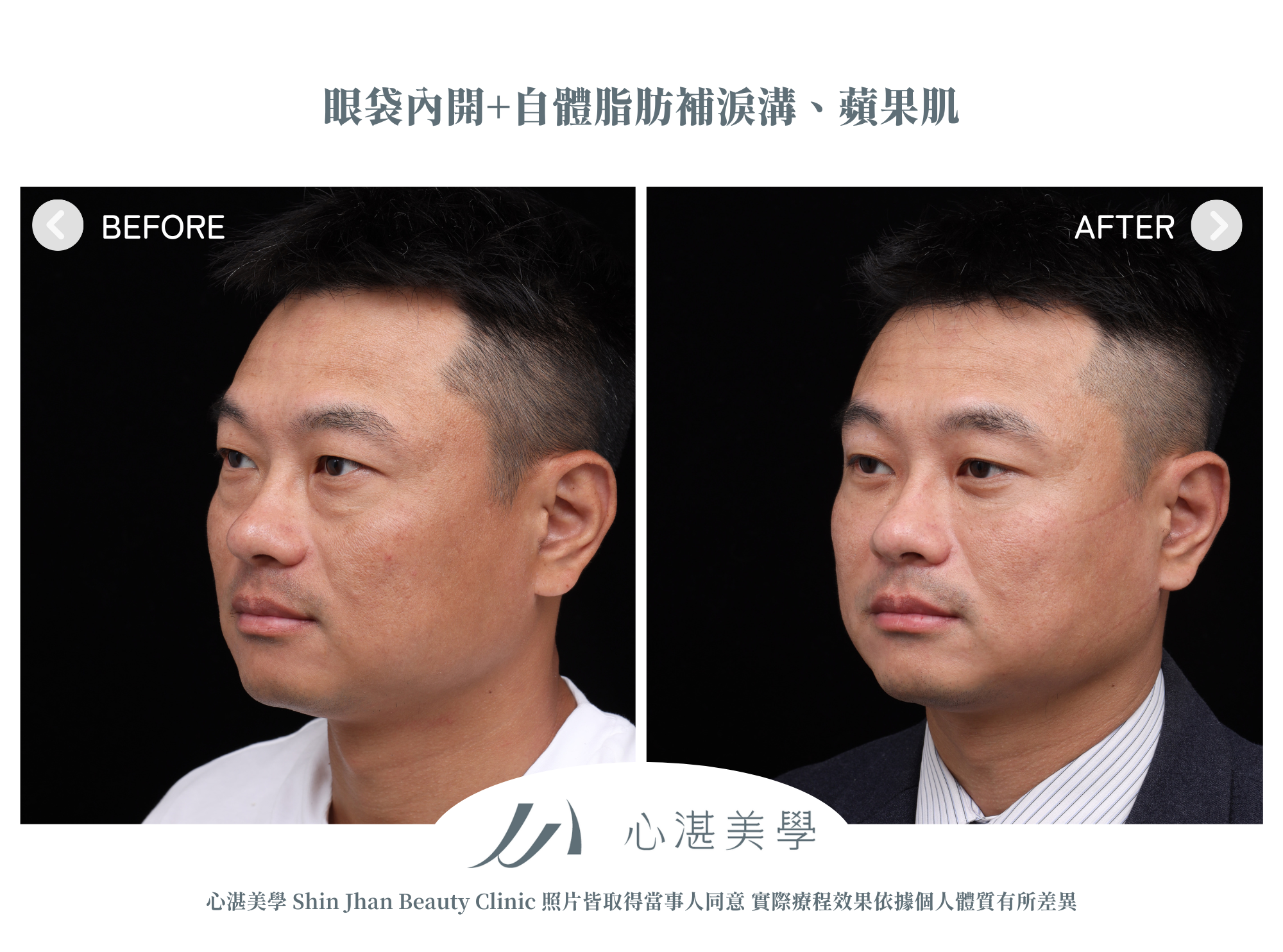 眼袋手術案例術前術後對比