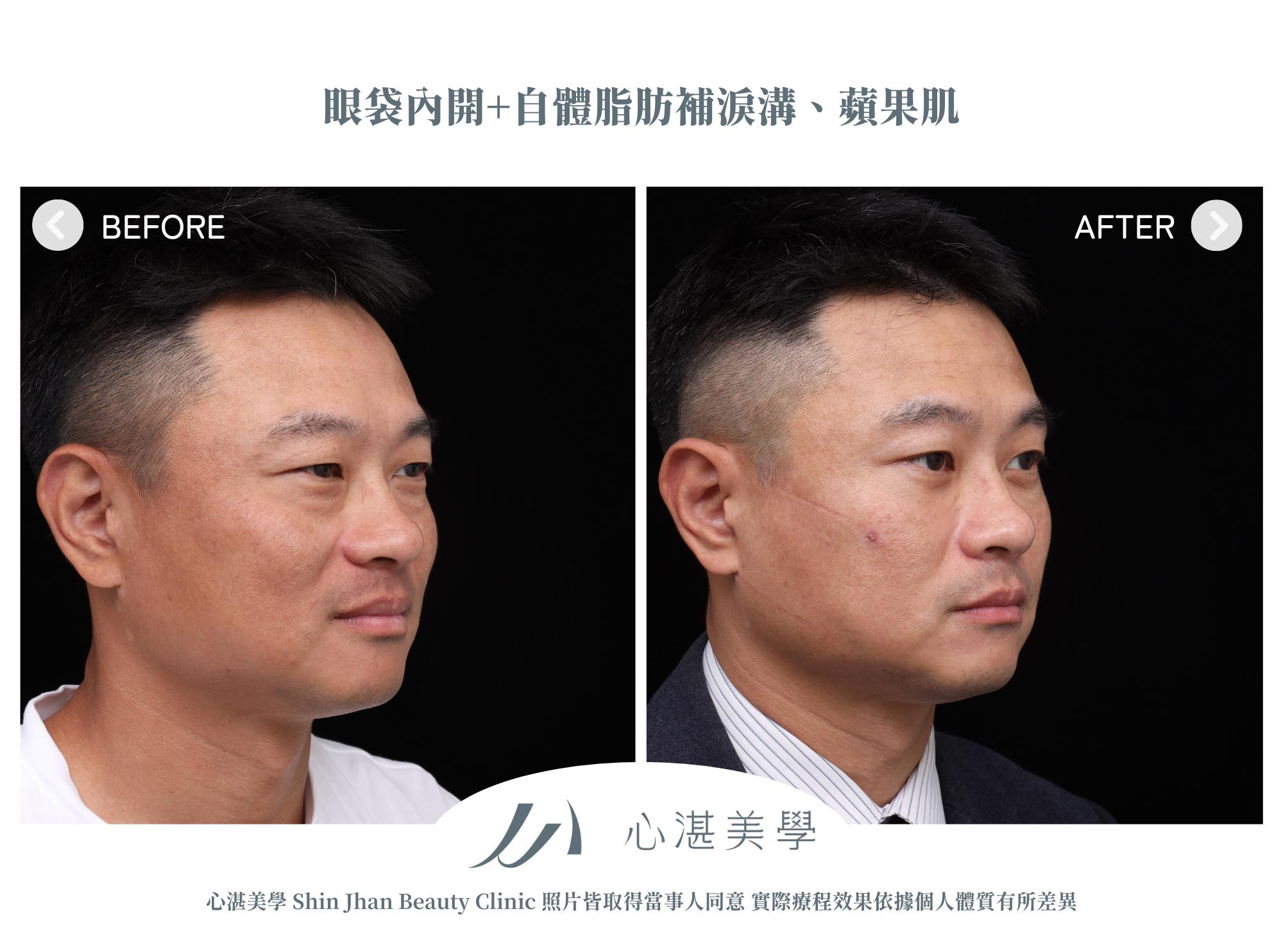眼袋手術案例術前術後對比