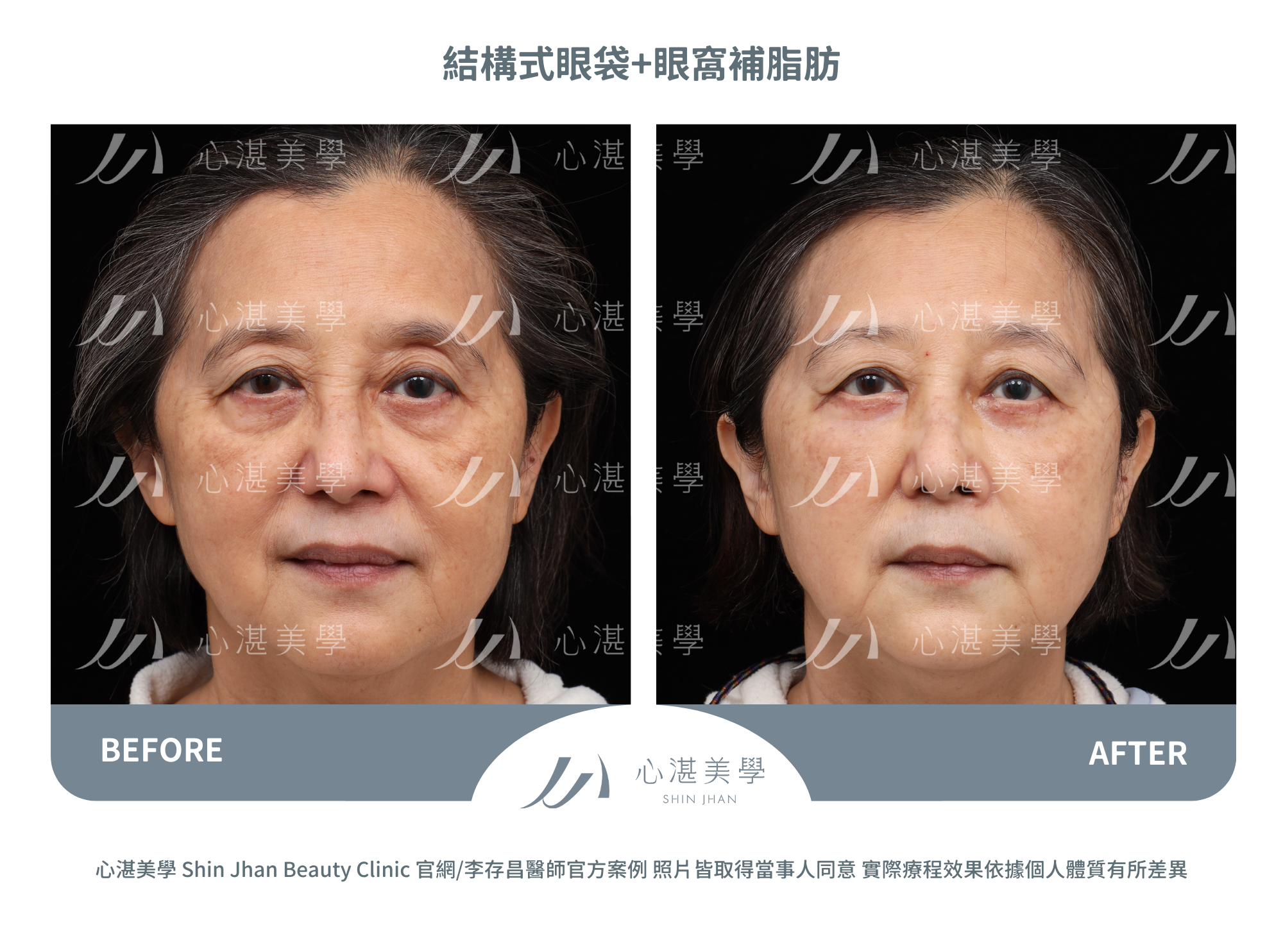 結構式眼袋手術+眼窩補脂肪術前術後對比案例