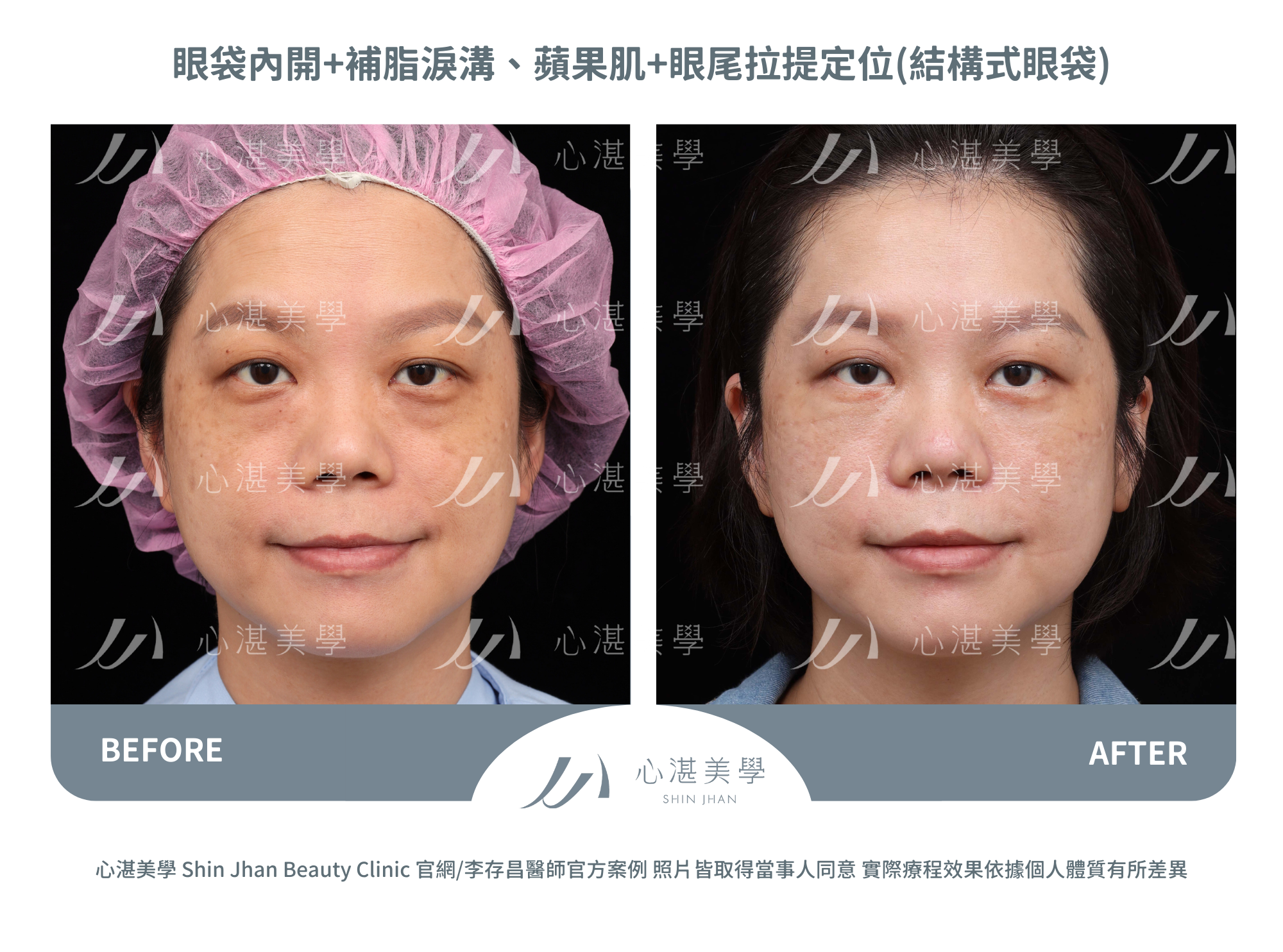 眼袋內開+自體脂肪補淚溝蘋果肌+眼尾拉提定位(結構式眼袋)案例分享