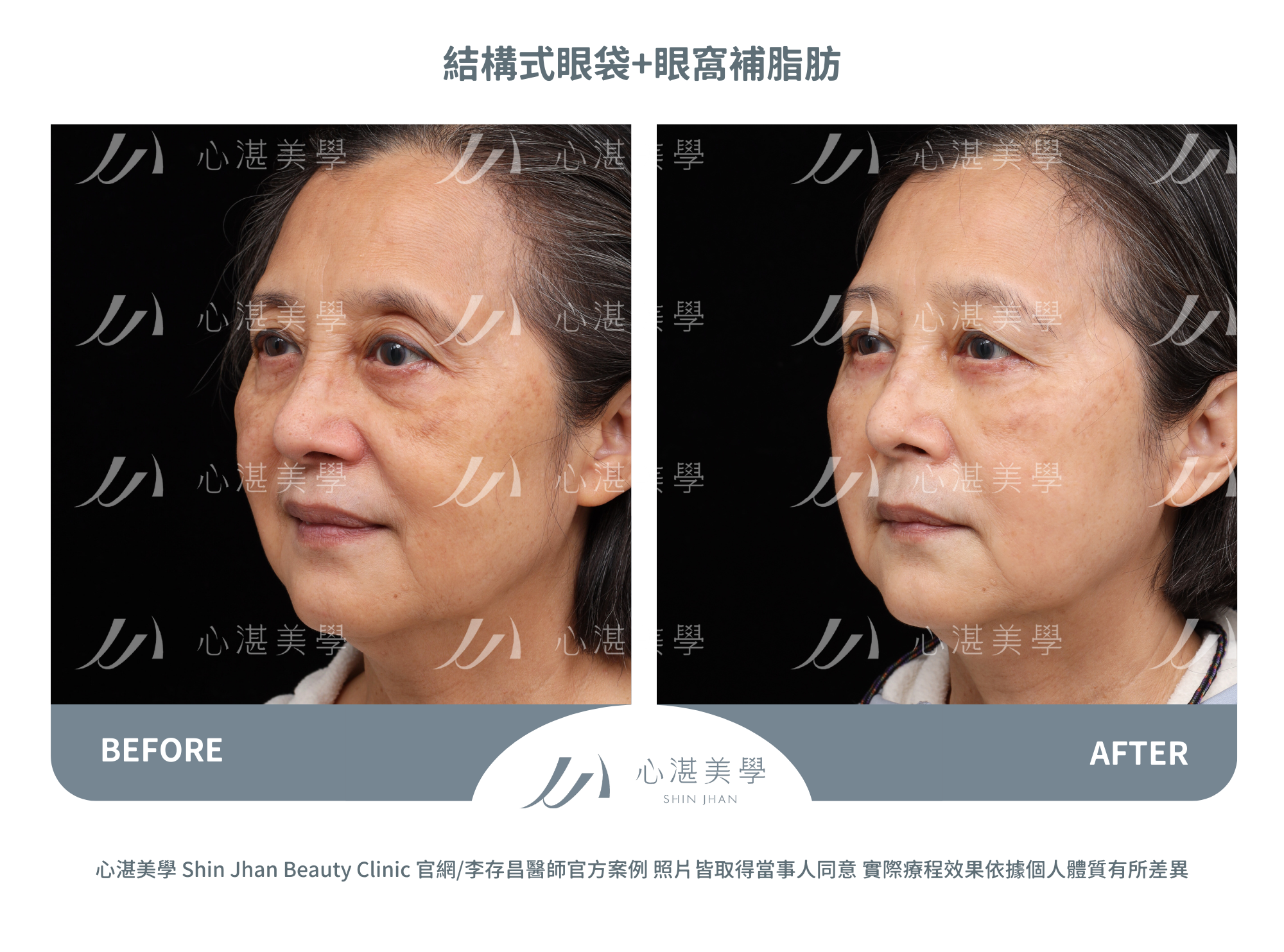 結構式眼袋手術+眼窩補脂肪術前術後對比案例