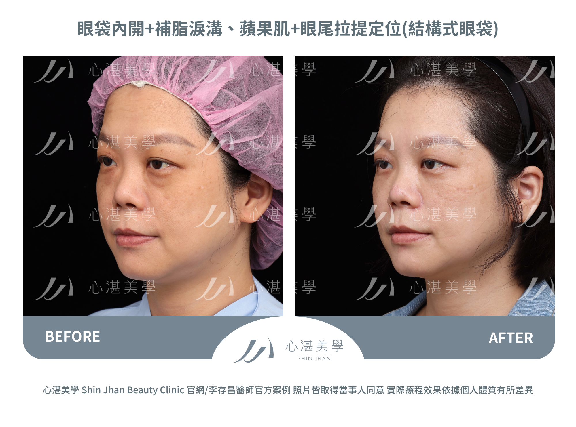 眼袋內開+自體脂肪補淚溝蘋果肌+眼尾拉提定位(結構式眼袋)案例分享