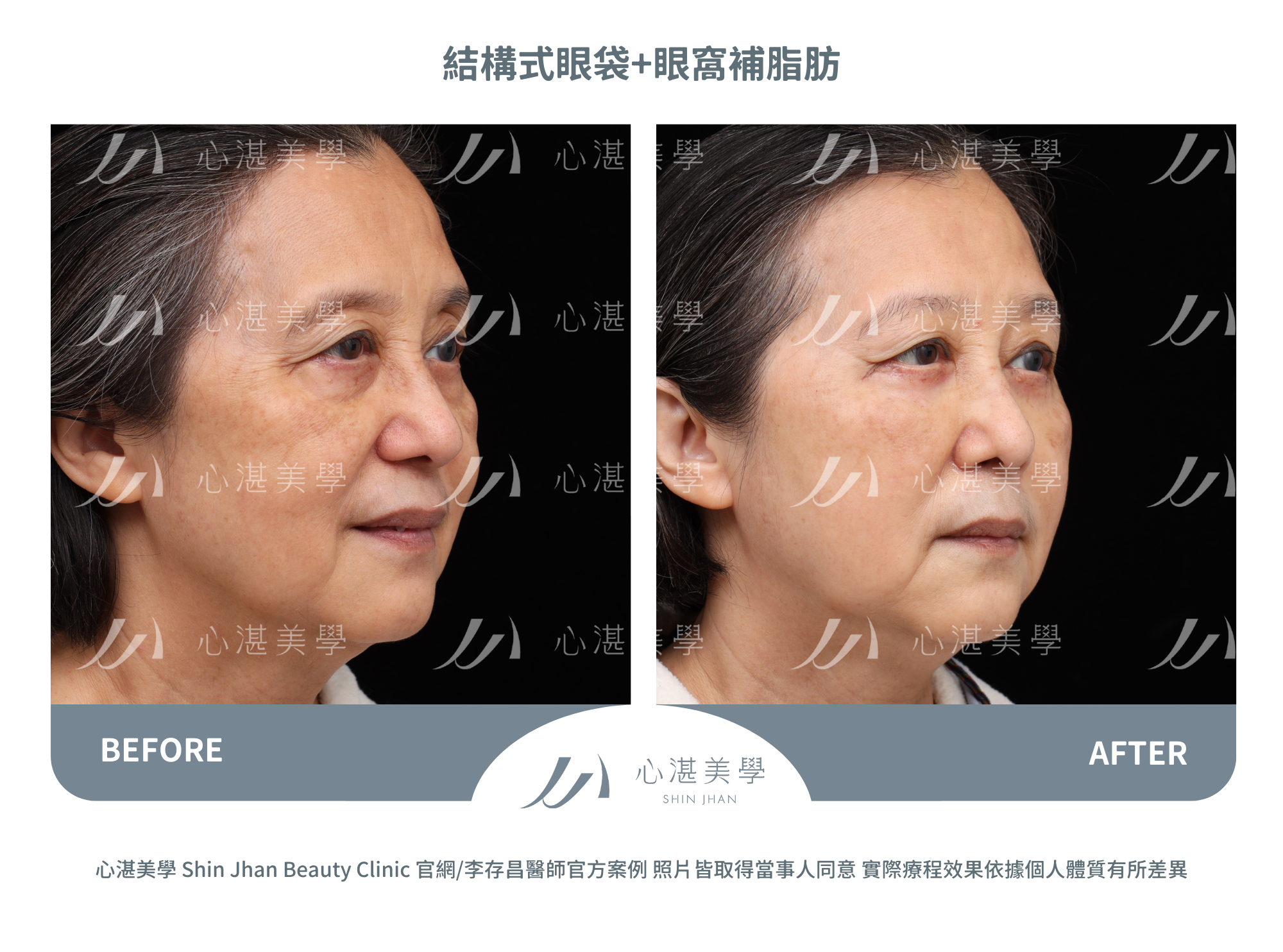 結構式眼袋手術+眼窩補脂肪術前術後對比案例