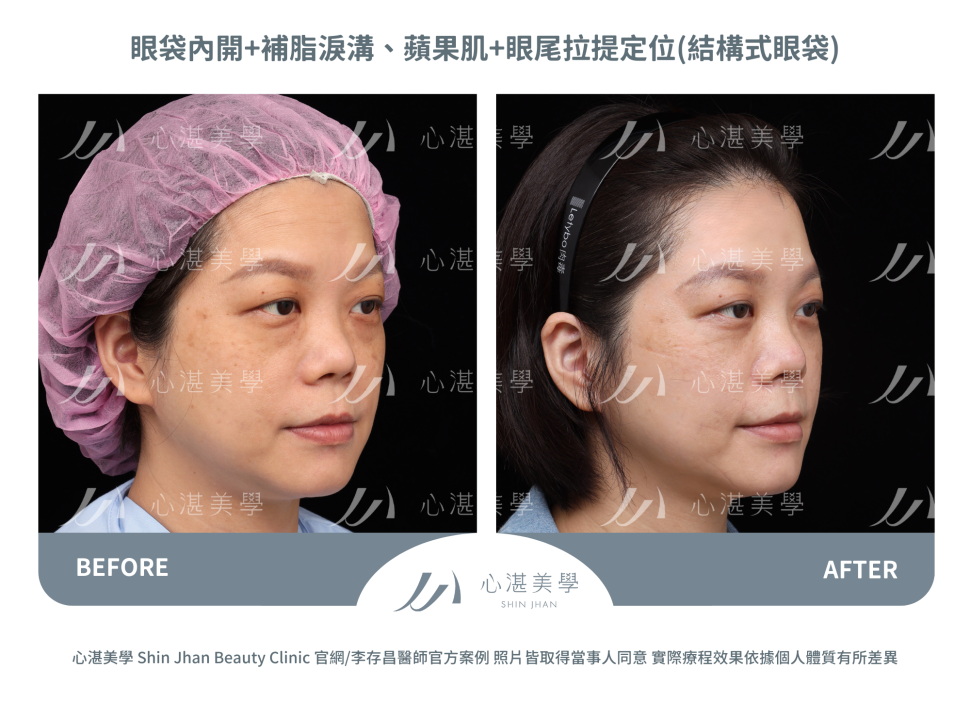 眼袋內開+自體脂肪補淚溝蘋果肌+眼尾拉提定位(結構式眼袋)
