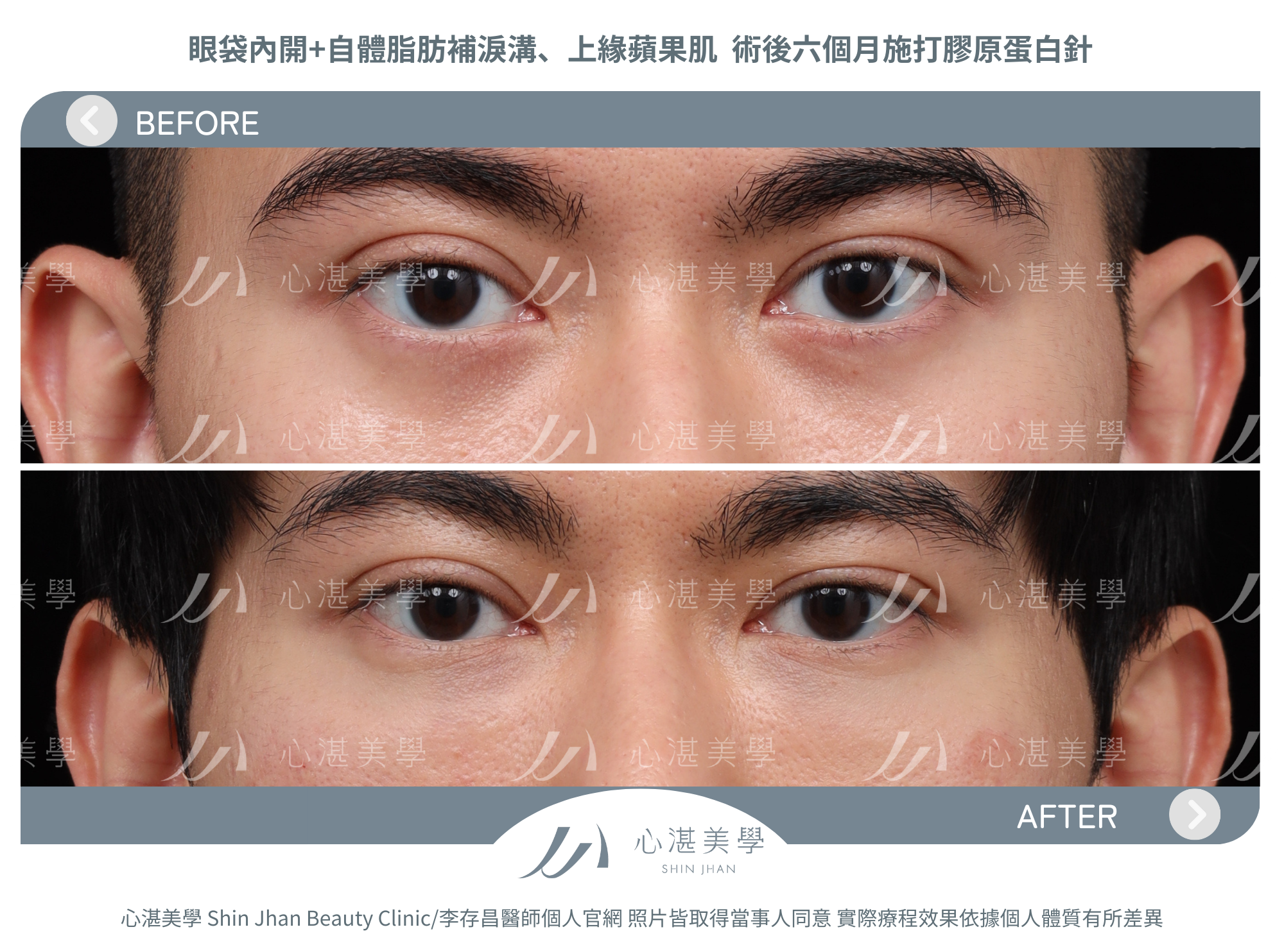 眼袋手術+術後六週施打膠原蛋白針術前術後對比案例