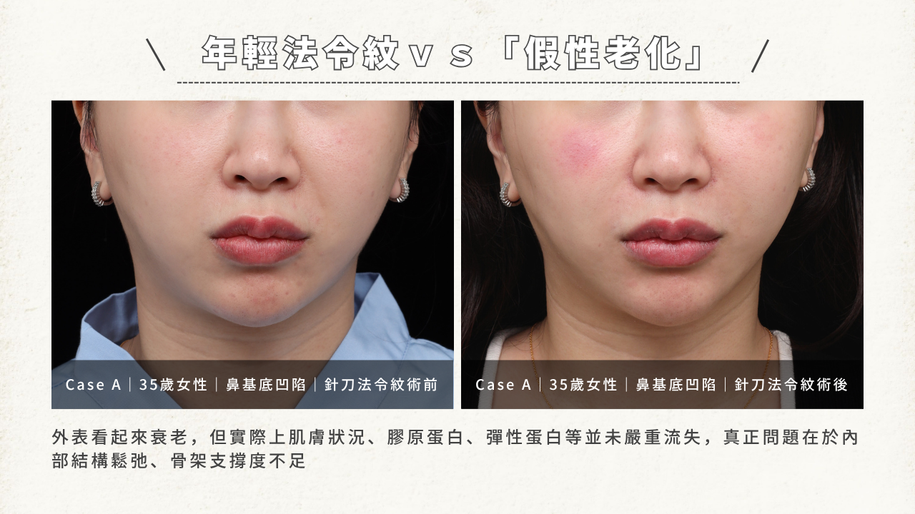 一張對比圖，顯示一位35歲女性在接受「針刀法令紋術」前後的效果。左圖為術前，法令紋和鼻基底凹陷較明顯。右圖為術後，法令紋和凹陷有所改善。文字標題為「年輕法令紋 vs 『假性老化』」，下方文字說明「外表看起來衰老，但實際是內部結構鬆弛、骨架支撐度不足」。