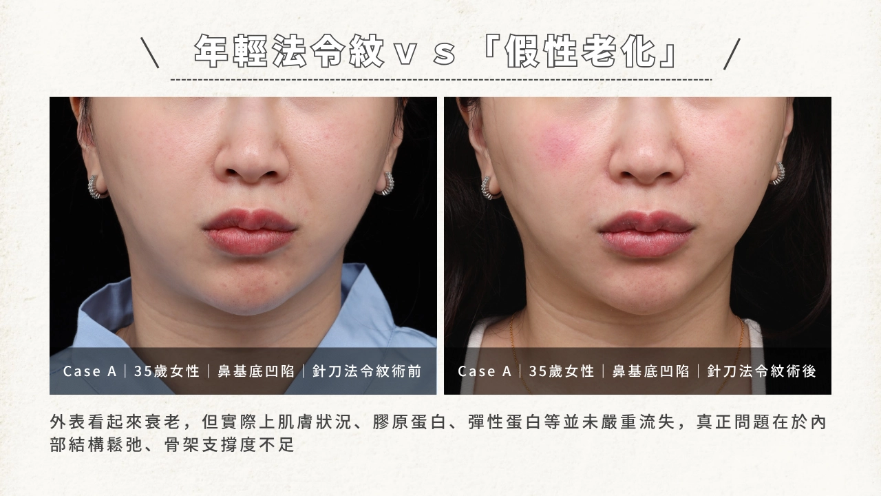 一張對比圖，顯示一位35歲女性在接受「針刀法令紋術」前後的效果。左圖為術前，法令紋和鼻基底凹陷較明顯。右圖為術後，法令紋和凹陷有所改善。文字標題為「年輕法令紋 vs 『假性老化』」，下方文字說明「外表看起來衰老，但實際是內部結構鬆弛、骨架支撐度不足」。