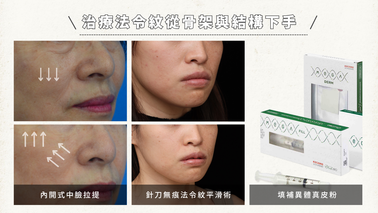 「內開式中臉拉提」。中間兩張圖為一位女性的臉部，顯示「針刀無痕法令紋平滑術」的效果。右邊顯示兩款填充物產品，文字說明「填補異體真皮粉」。標題為「治療法令紋從骨架與結構下手」。