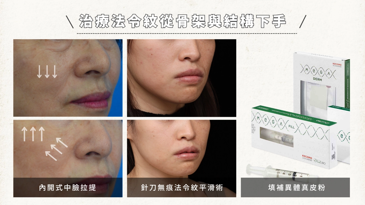 「內開式中臉拉提」。中間兩張圖為一位女性的臉部，顯示「針刀無痕法令紋平滑術」的效果。右邊顯示兩款填充物產品，文字說明「填補異體真皮粉」。標題為「治療法令紋從骨架與結構下手」。