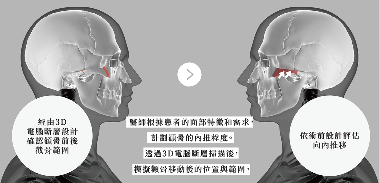 顴骨內推手術主要針對顴骨過高或過寬者，透過調整顴骨位置，讓臉部輪廓更柔和、立體。它能改善臉型、減少老化跡象，使臉部看起來更年輕和諧。