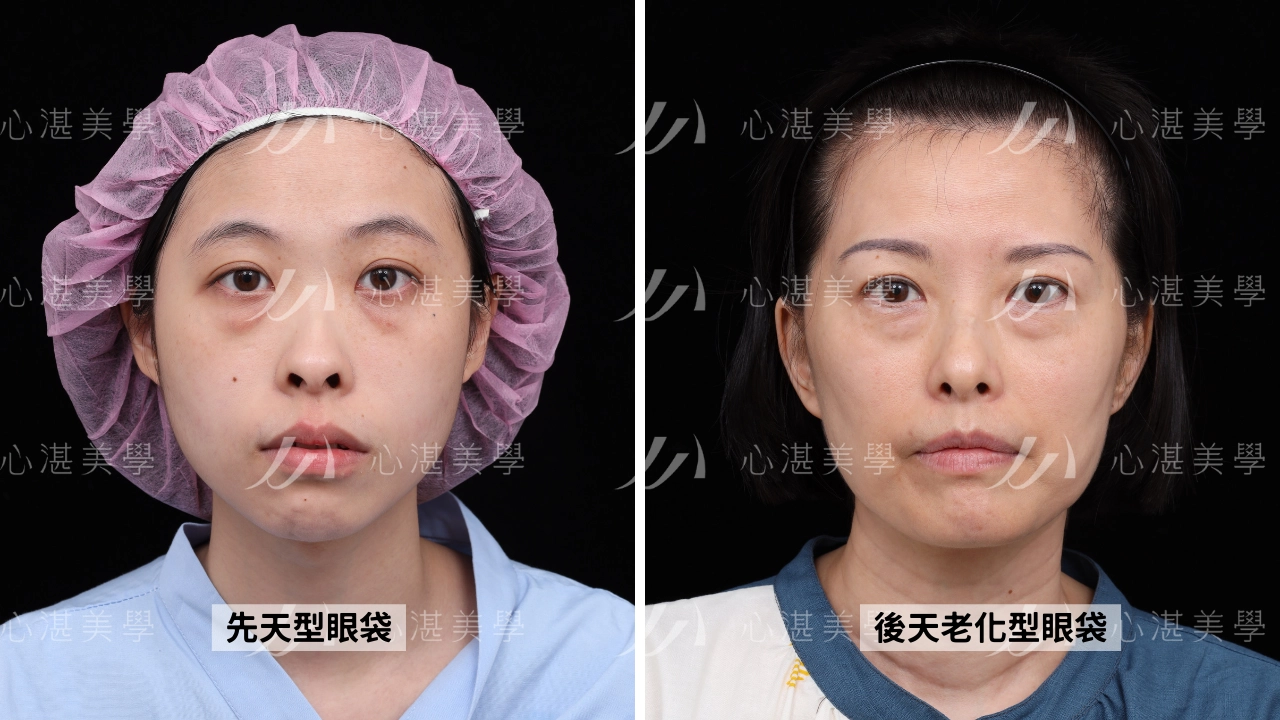 遺傳性眼袋vs老化型眼袋