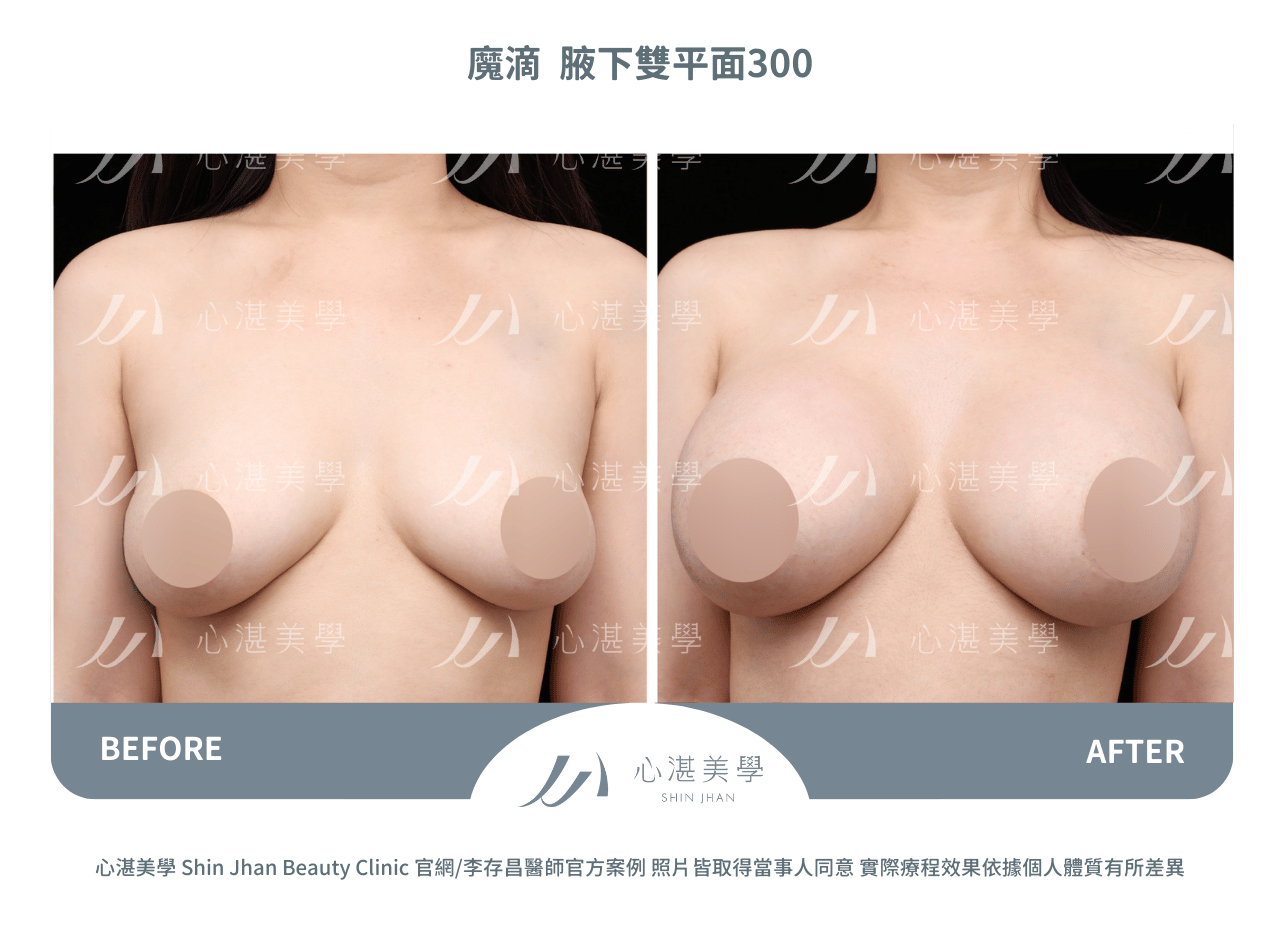 魔滴隆乳術前術後分享
