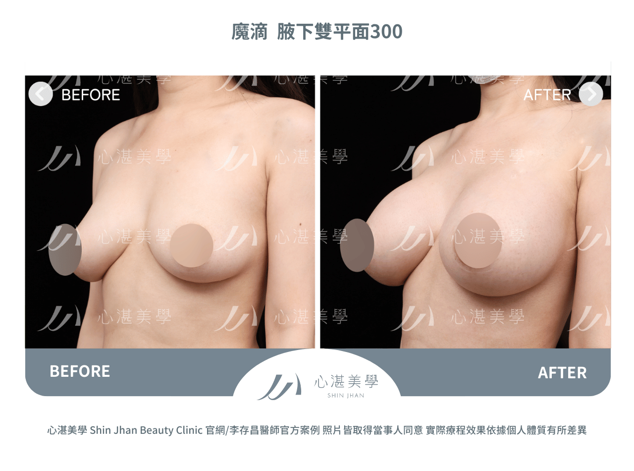 魔滴隆乳術前術後分享