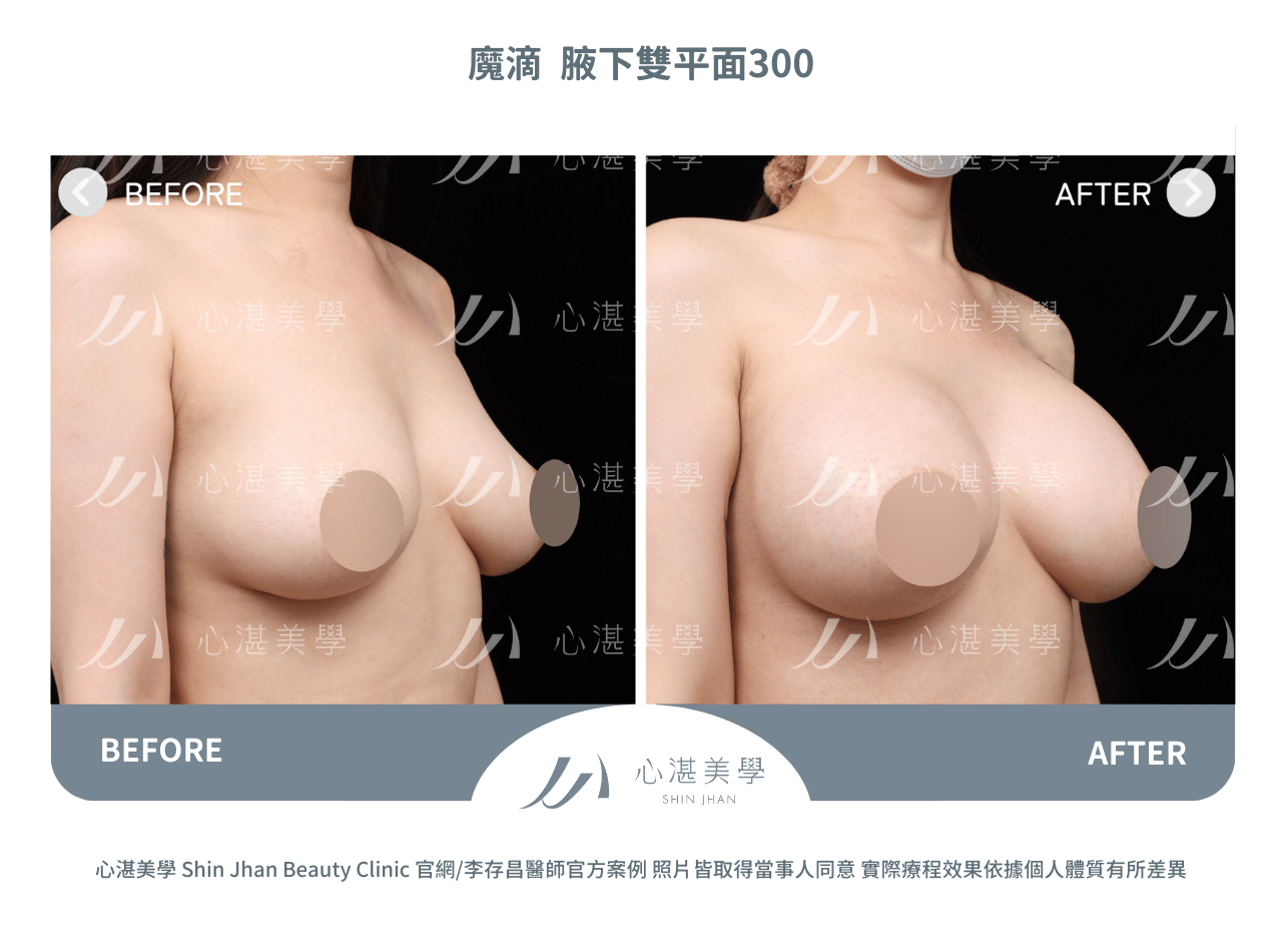 魔滴隆乳術前術後分享