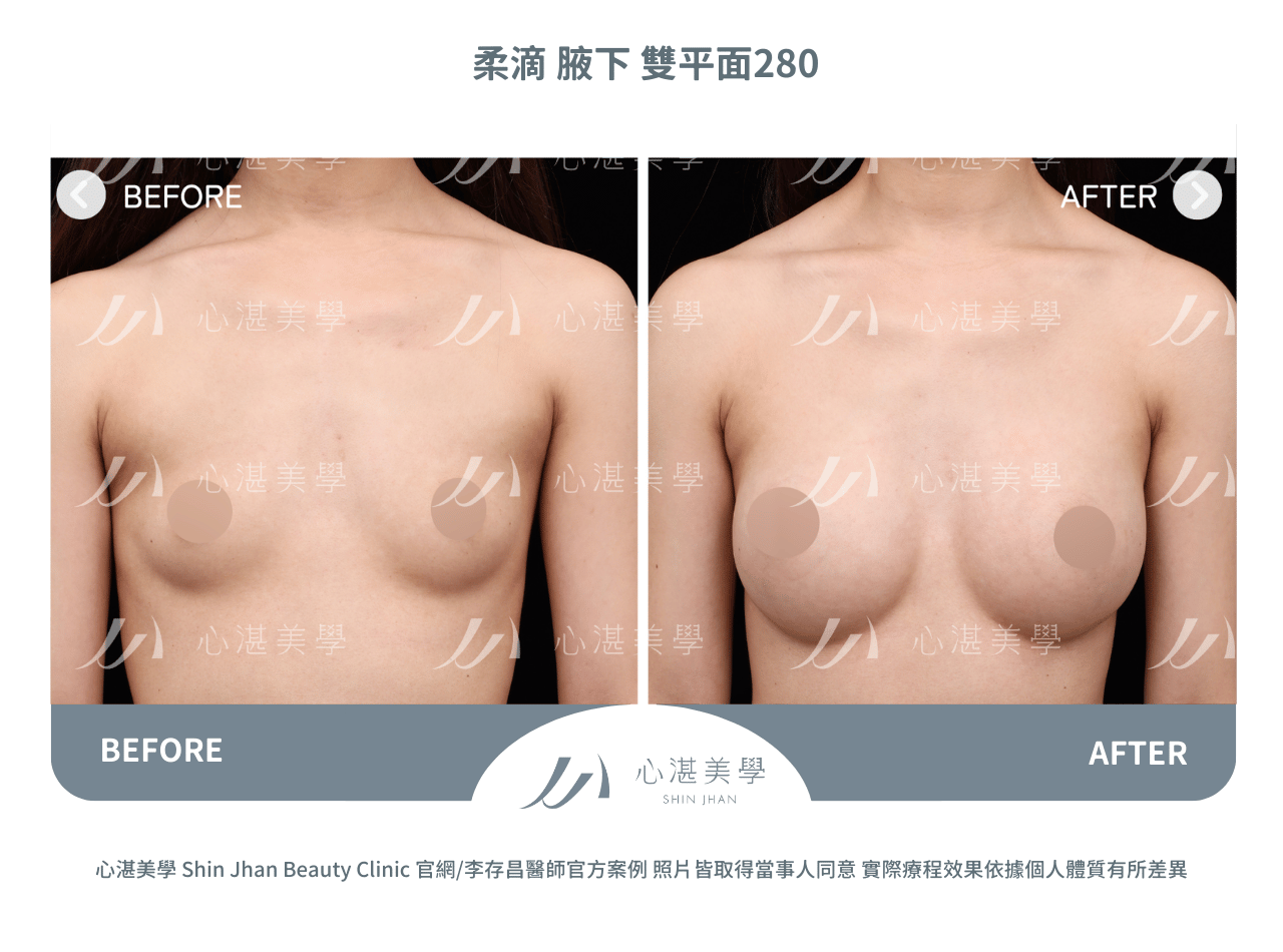 柔滴隆乳術前術後分享