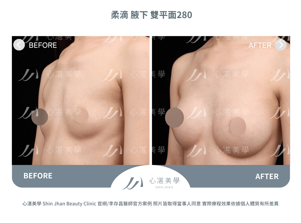 柔滴隆乳術前術後分享