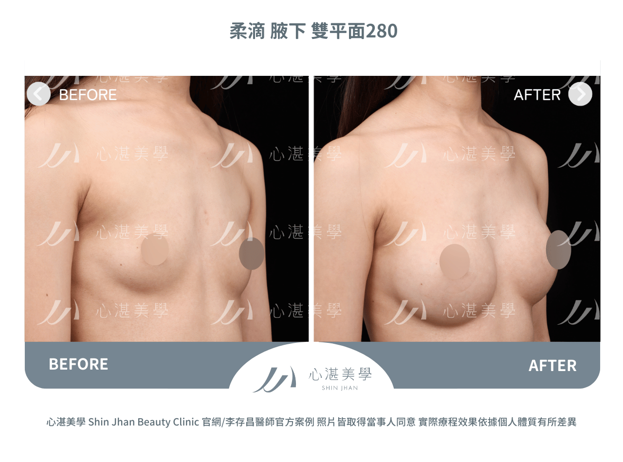 柔滴隆乳術前術後分享