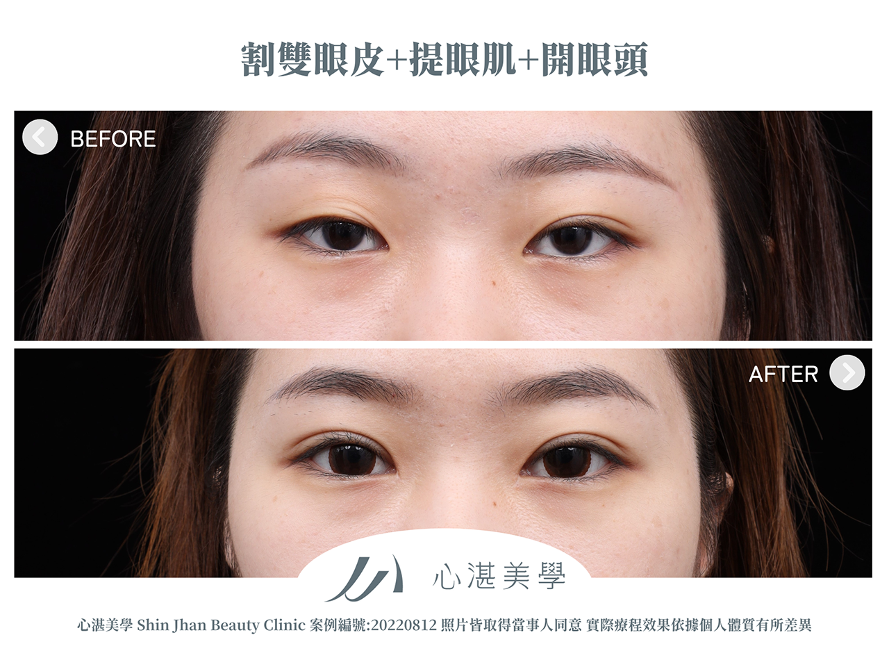 割雙眼皮+提眼瞼肌+開眼頭案例分享